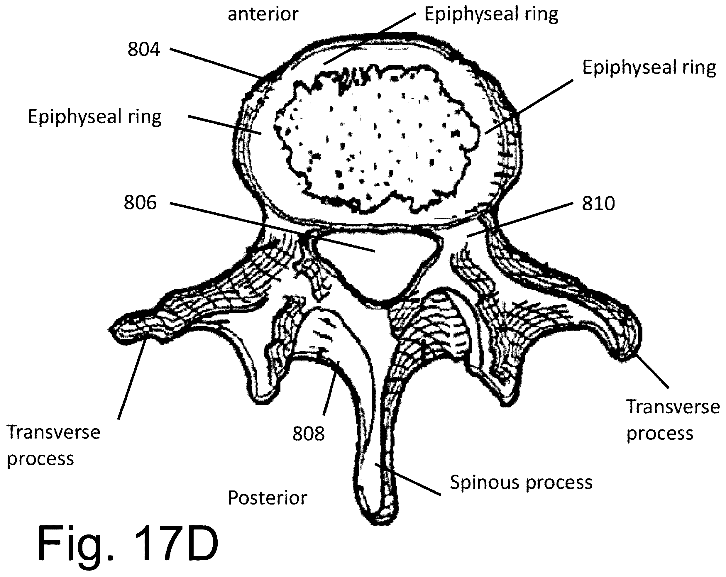 Patent US12167973 Figure 18 – Spinal fixation devices and methods of use