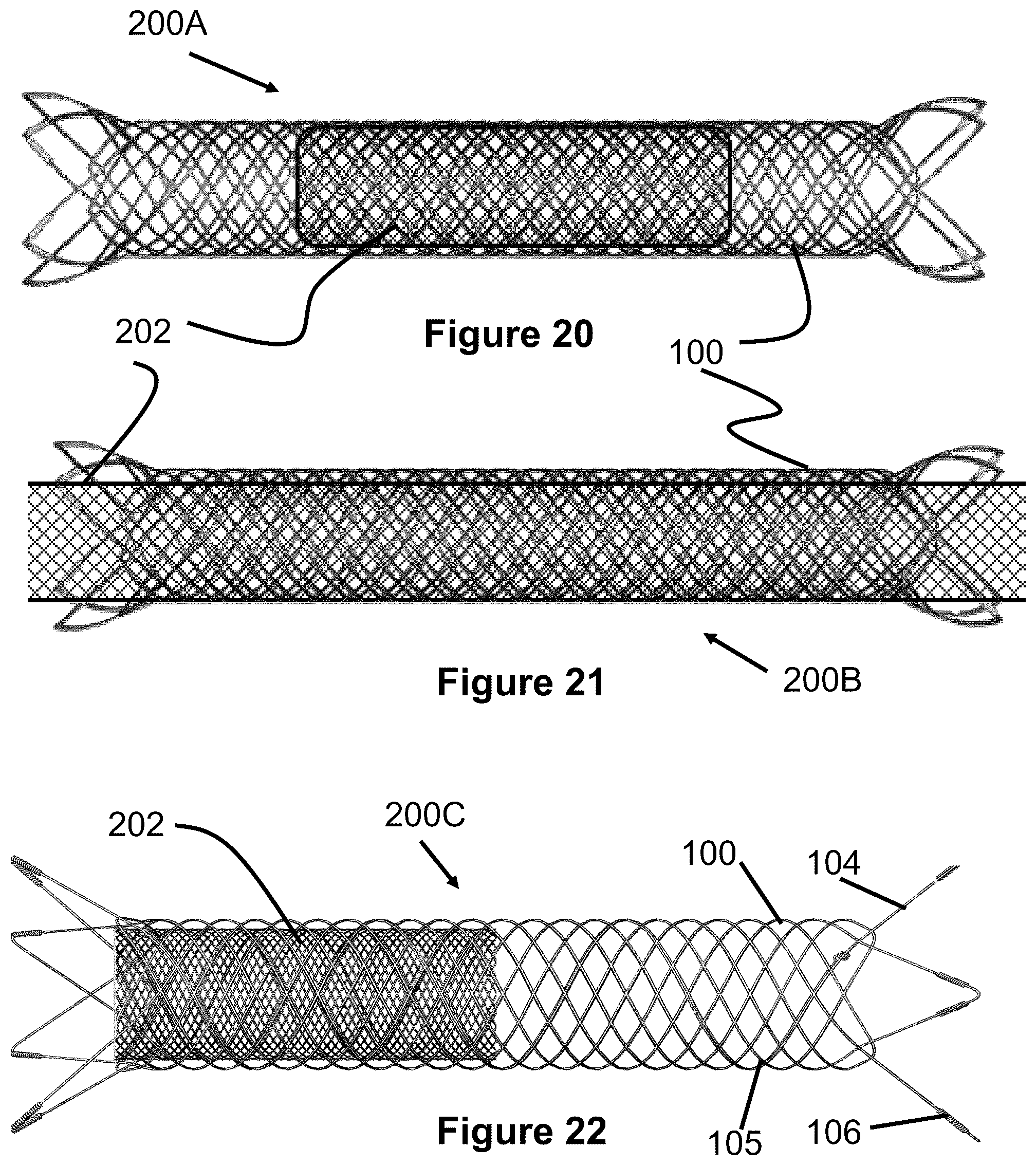Patent US12167975 Figure 12 – Stent and stent delivery device