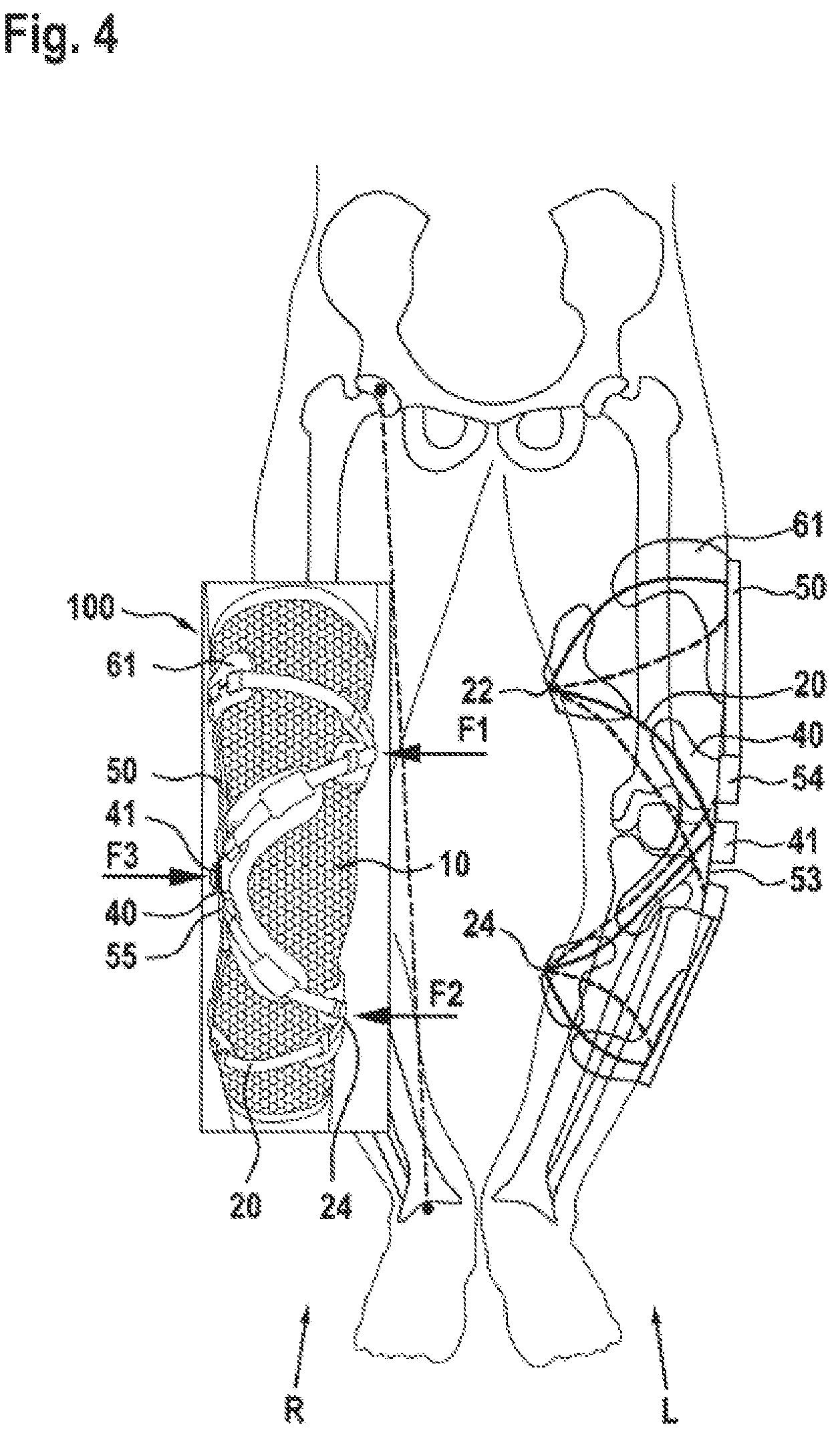 Patent US12167977 Figure 5 – Limb orthosis, in particular knee brace