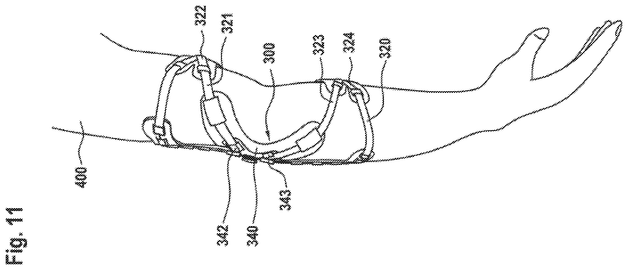 Patent US12167977 Figure 12 – Limb orthosis, in particular knee brace