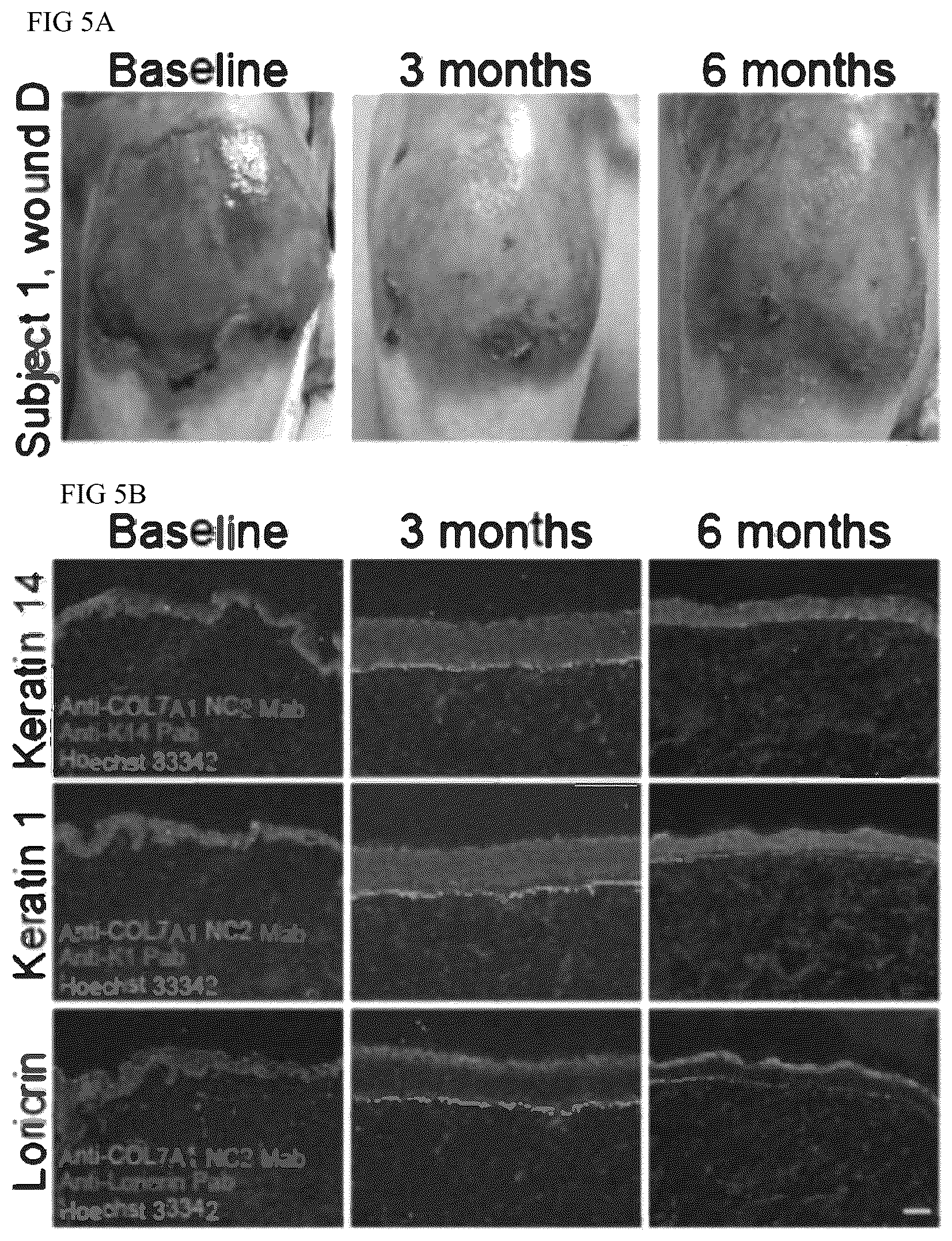 Patent US12173314 Figure 5 – Gene therapy for recessive dystrophic epidermolysis bullosa using genetically corrected autologous keratinocytes