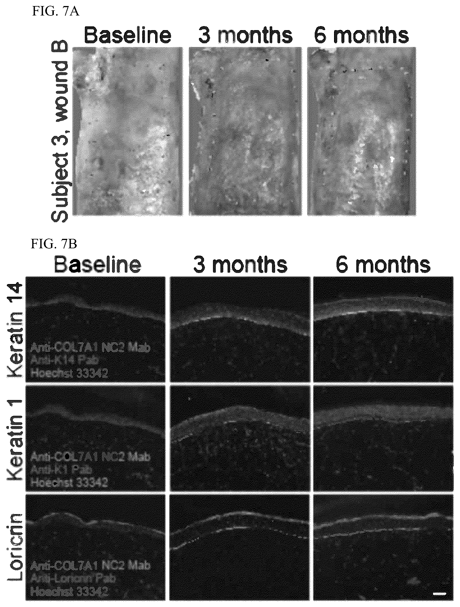 Patent US12173314 Figure 7 – Gene therapy for recessive dystrophic epidermolysis bullosa using genetically corrected autologous keratinocytes