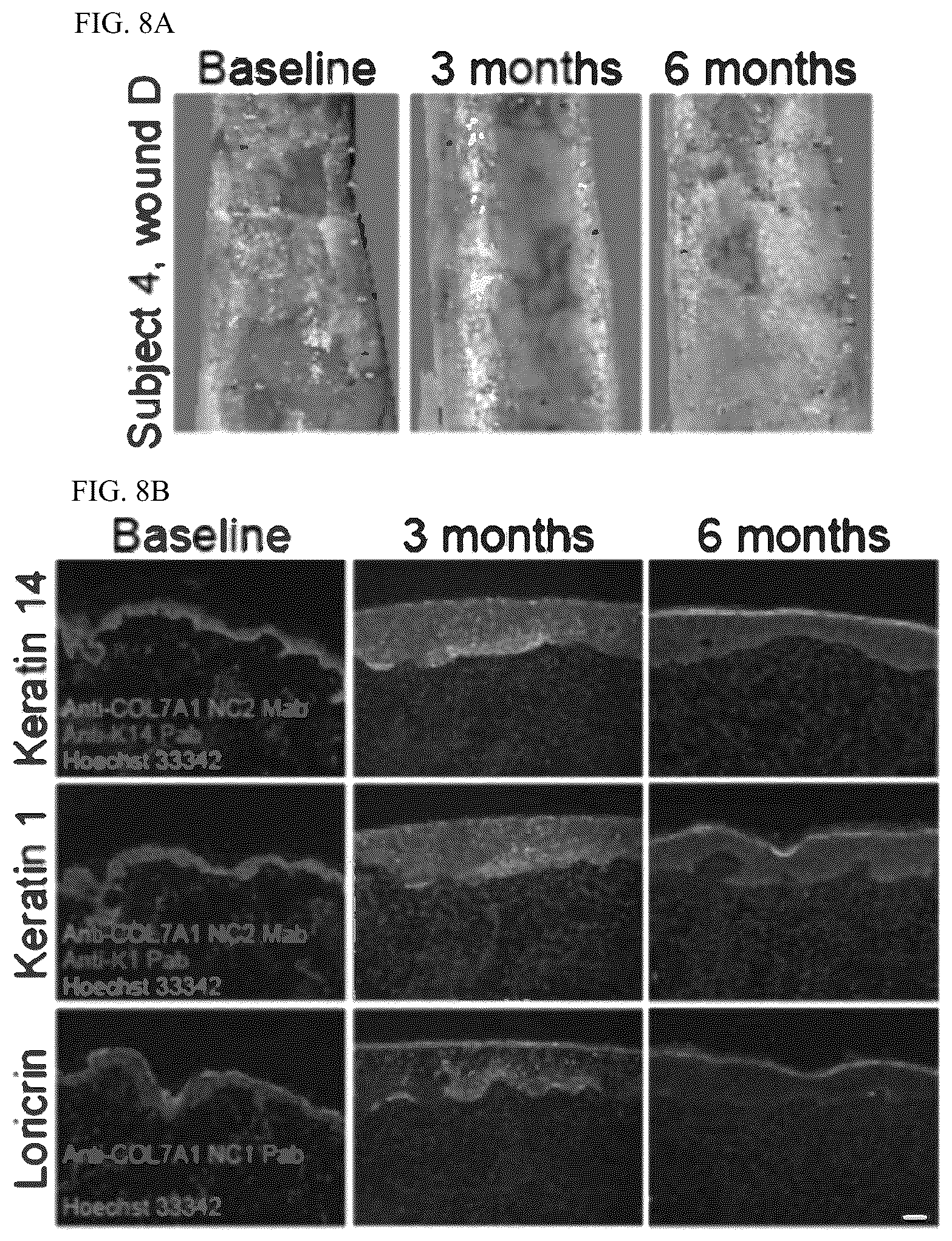 Patent US12173314 Figure 8 – Gene therapy for recessive dystrophic epidermolysis bullosa using genetically corrected autologous keratinocytes