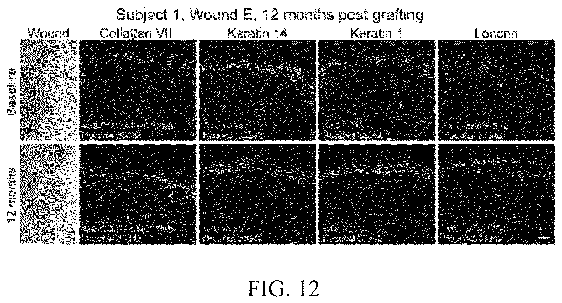 Patent US12173314 Figure 11 – Gene therapy for recessive dystrophic epidermolysis bullosa using genetically corrected autologous keratinocytes