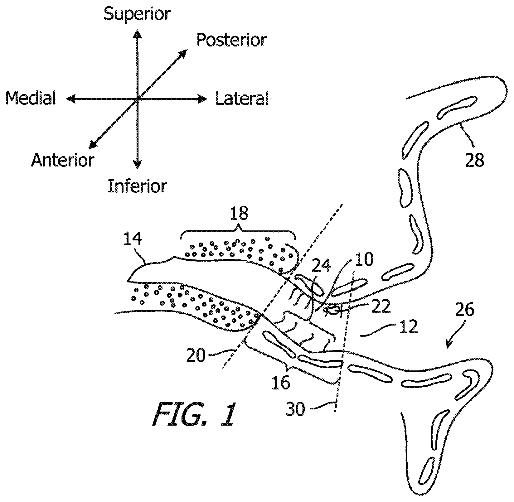 Patent US12174014 Figure 1 – Canal hearing device sizer tools, systems and methods