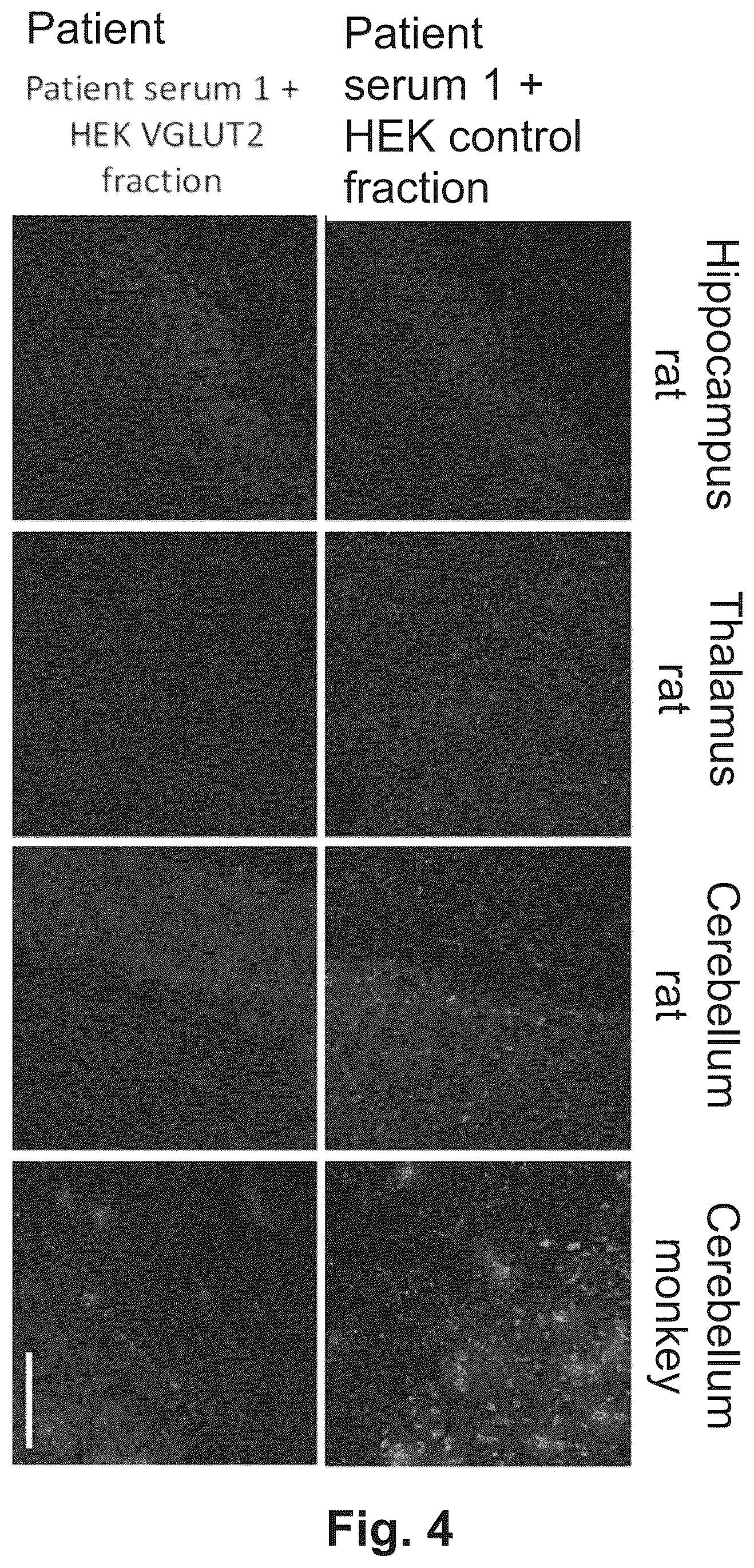 Patent US12174186 Figure 4 – Method and reagents for the detection of an autoantibody