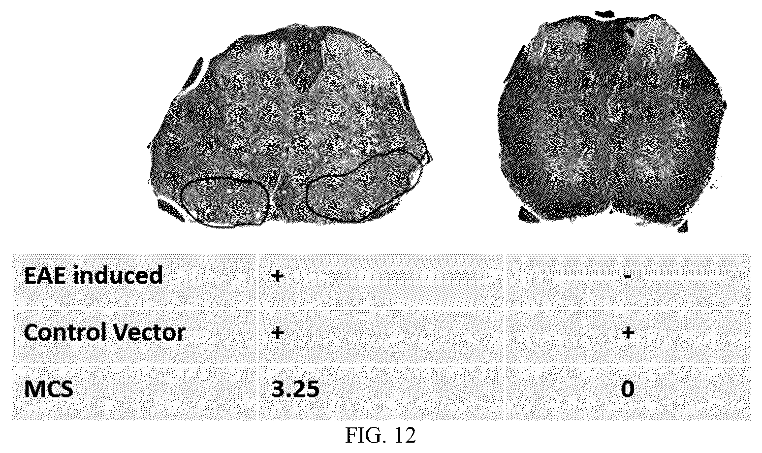 Patent US12297444 Figure 11 – AAV-based gene therapies for treatment of autoimmune diseases