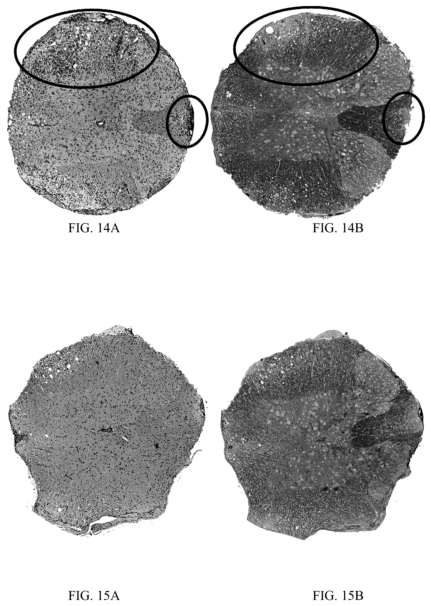 Patent US12297444 Figure 15 – AAV-based gene therapies for treatment of autoimmune diseases