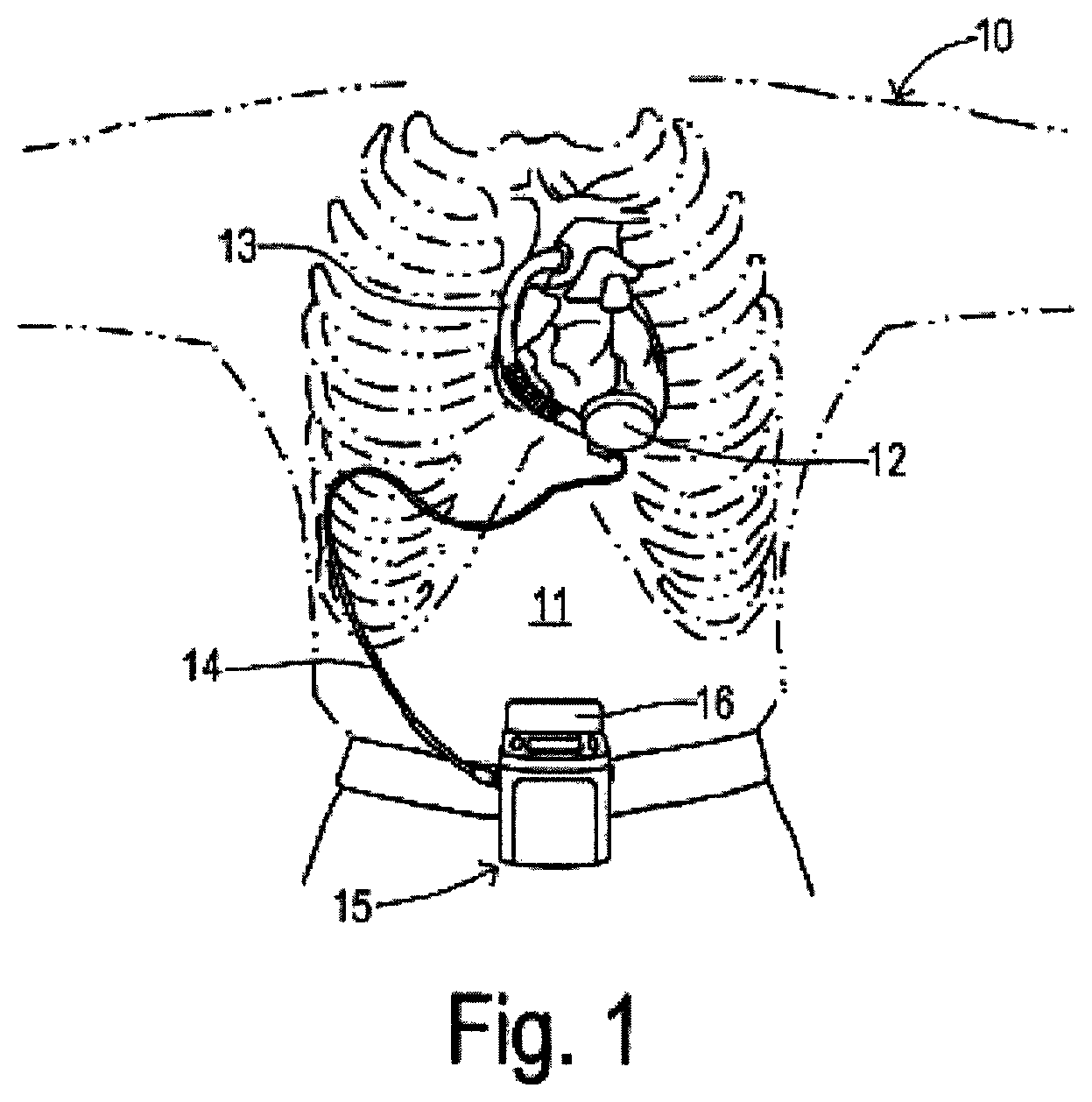 Patent US12297836 Figure 1 – Alternating pump gaps
