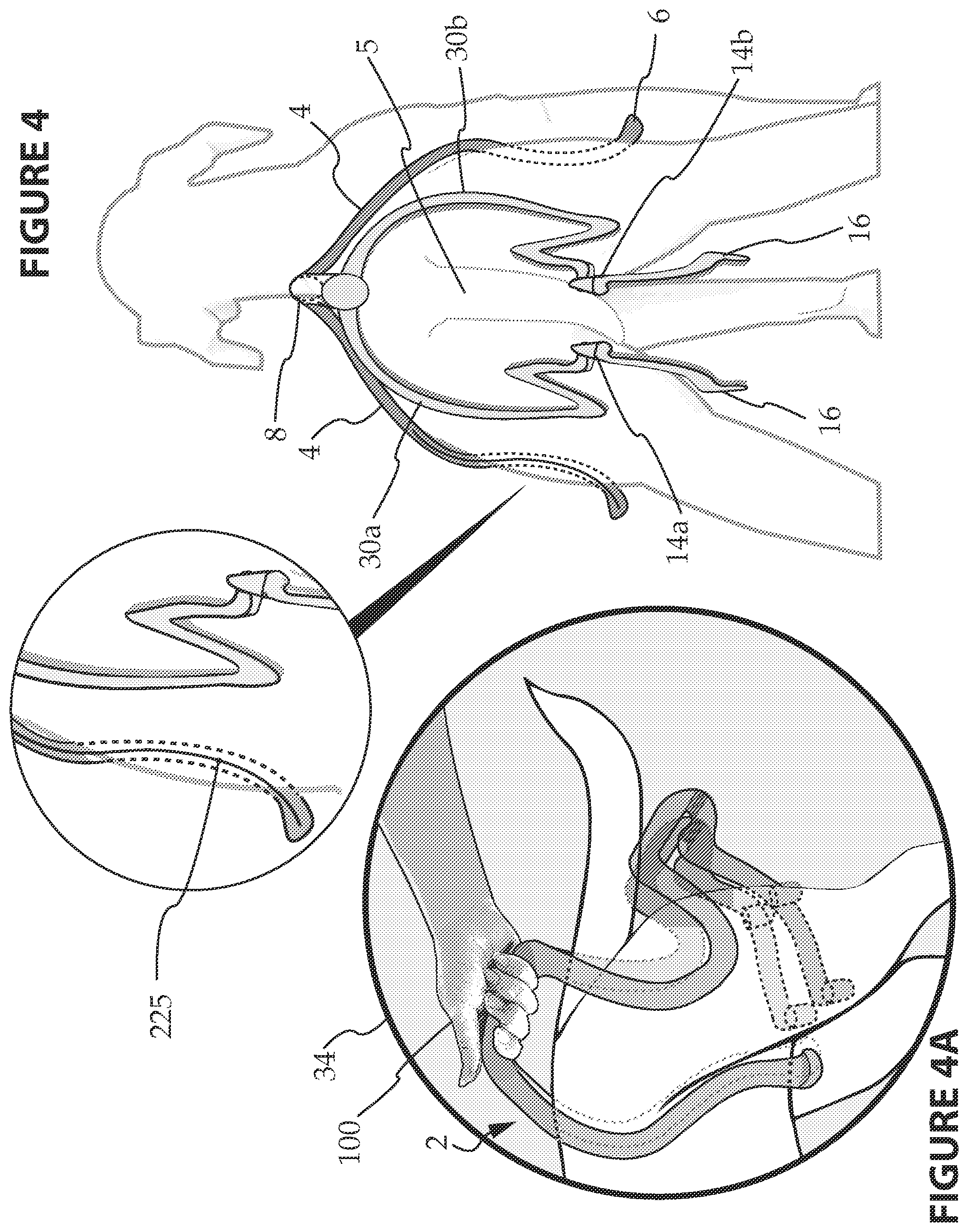 Patent US12302863 Figure 4 – Quick attach/detach form-fitting pet potty handle with rapid-deploy/disposable waste receptacle/bag and method for using same