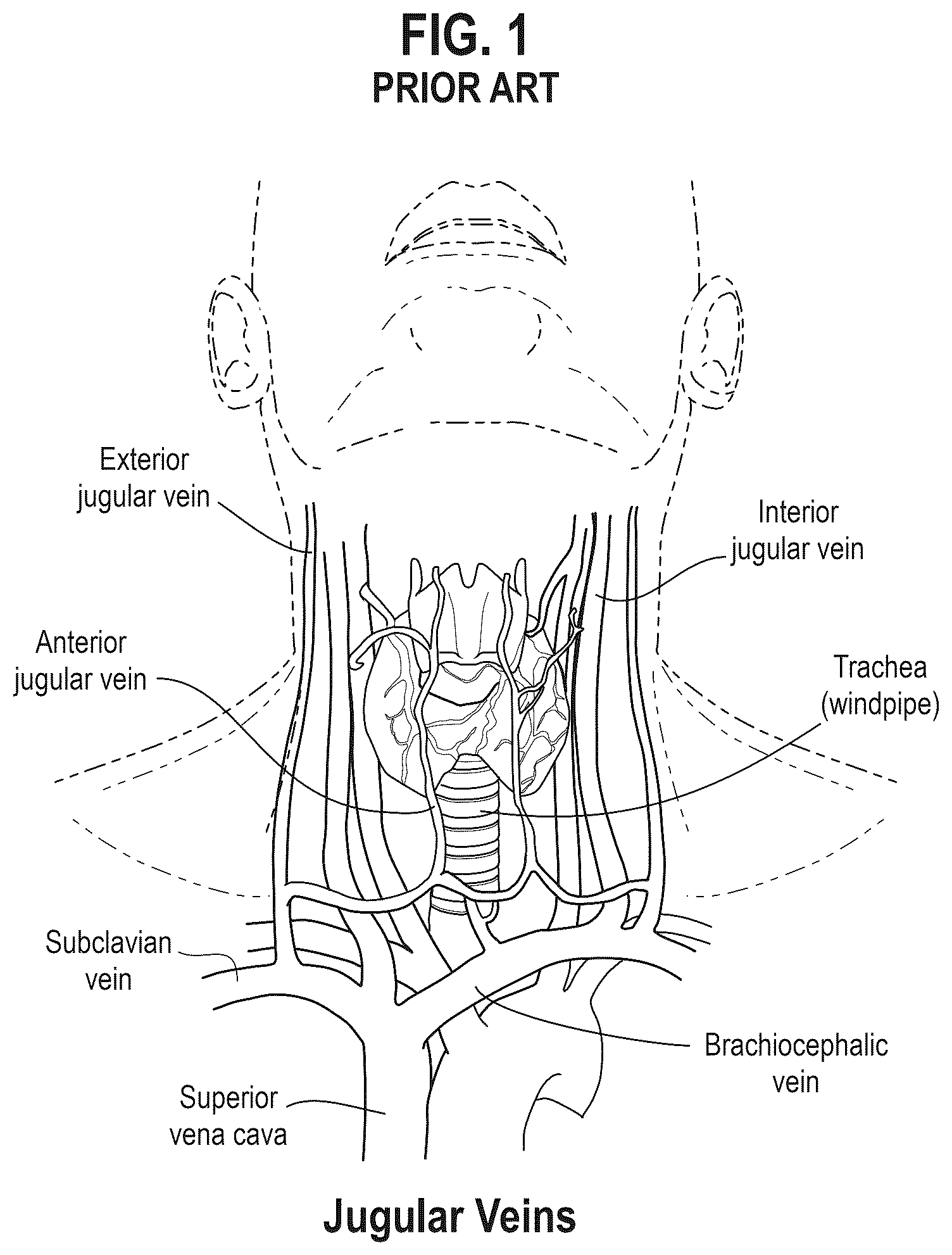 Patent US12302959 Figure 1 – Neck laceration prevention device