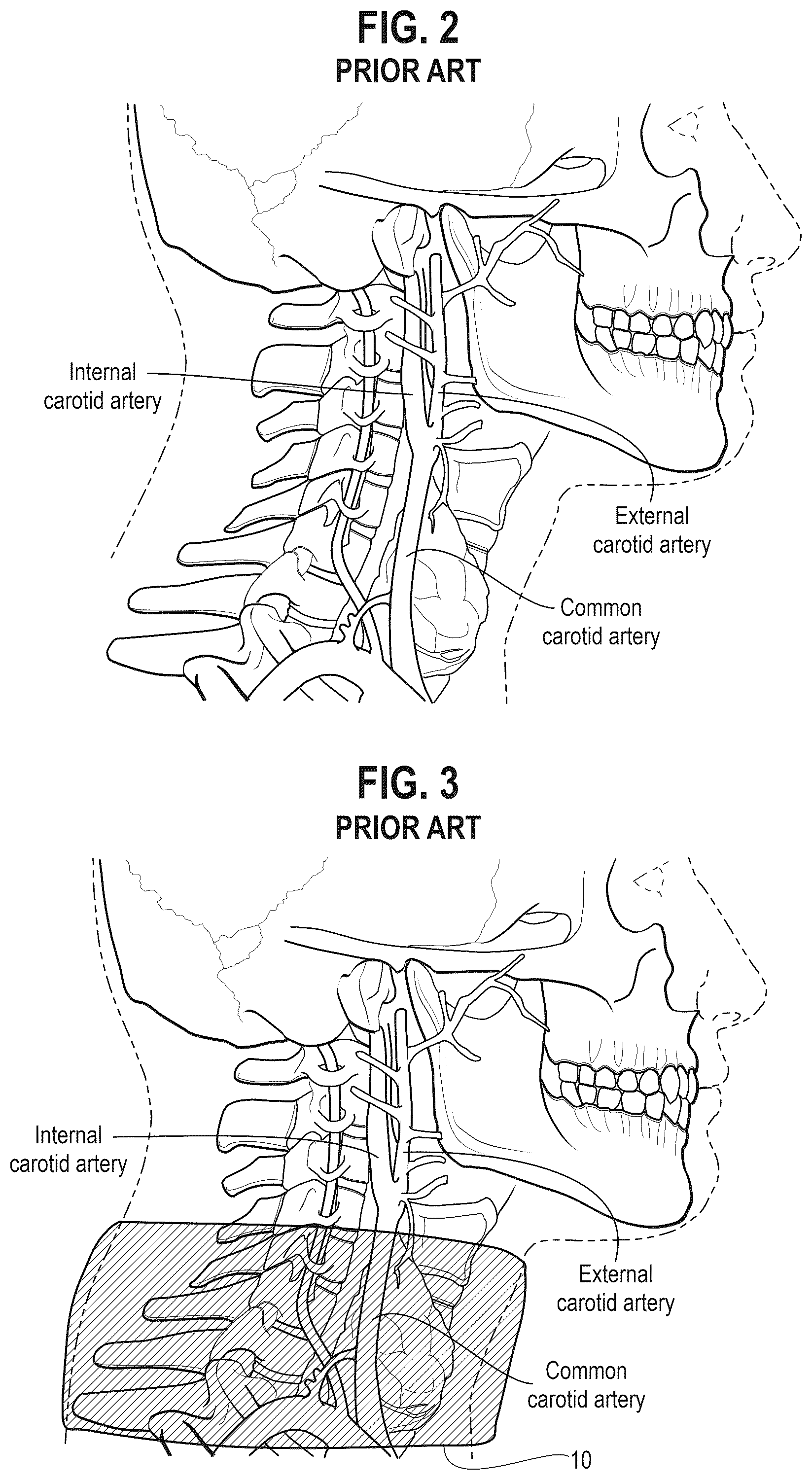 Patent US12302959 Figure 2 – Neck laceration prevention device
