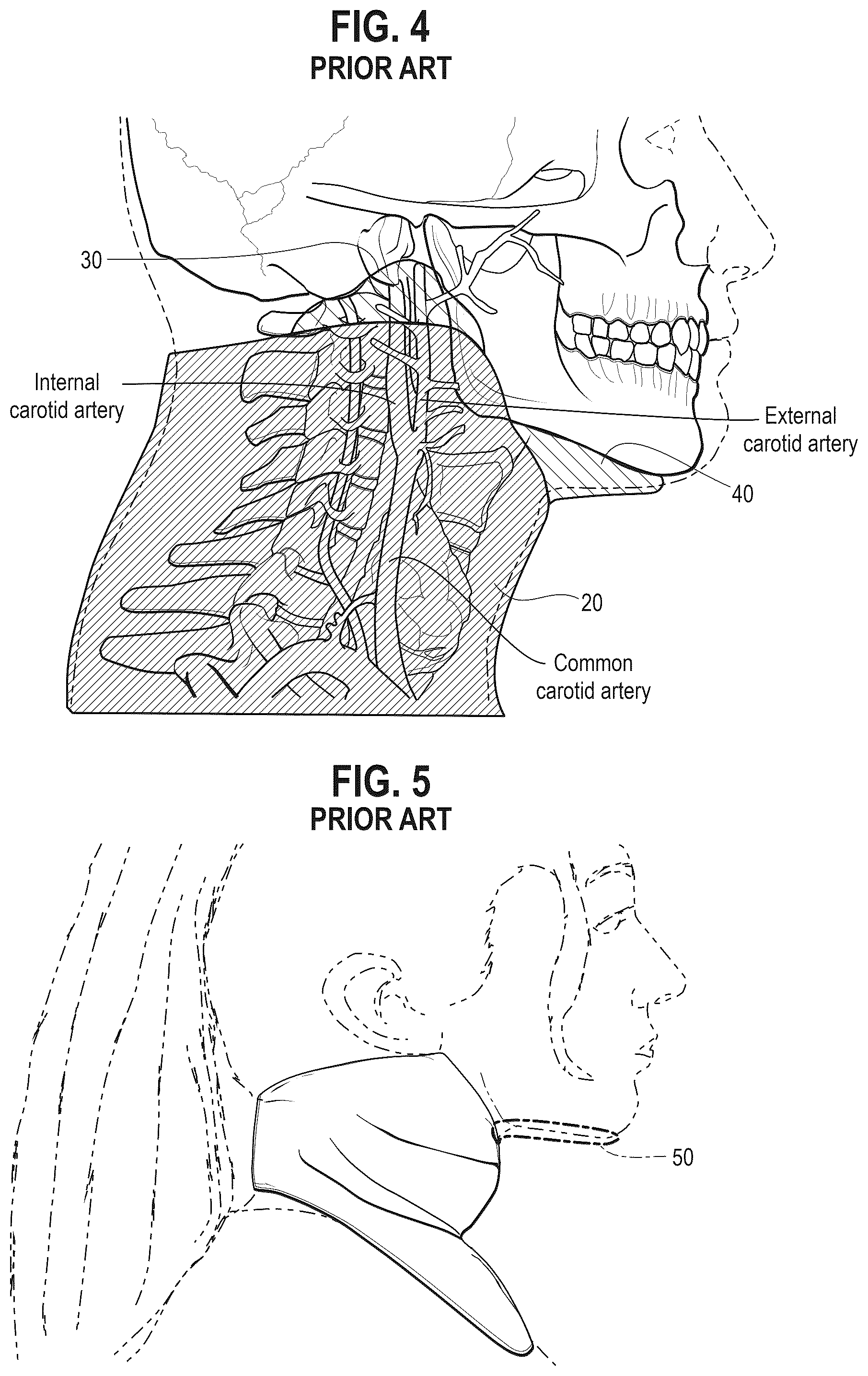 Patent US12302959 Figure 3 – Neck laceration prevention device