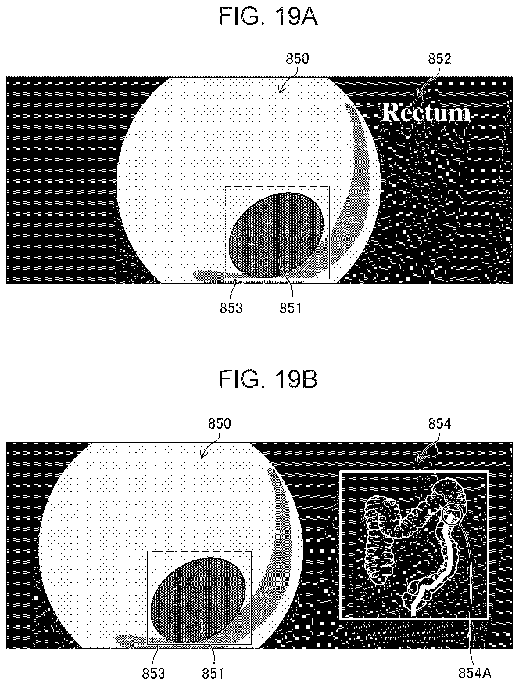 Patent US12303097 Figure 15 – Medical image processing apparatus, endoscope system, and medical image processing method
