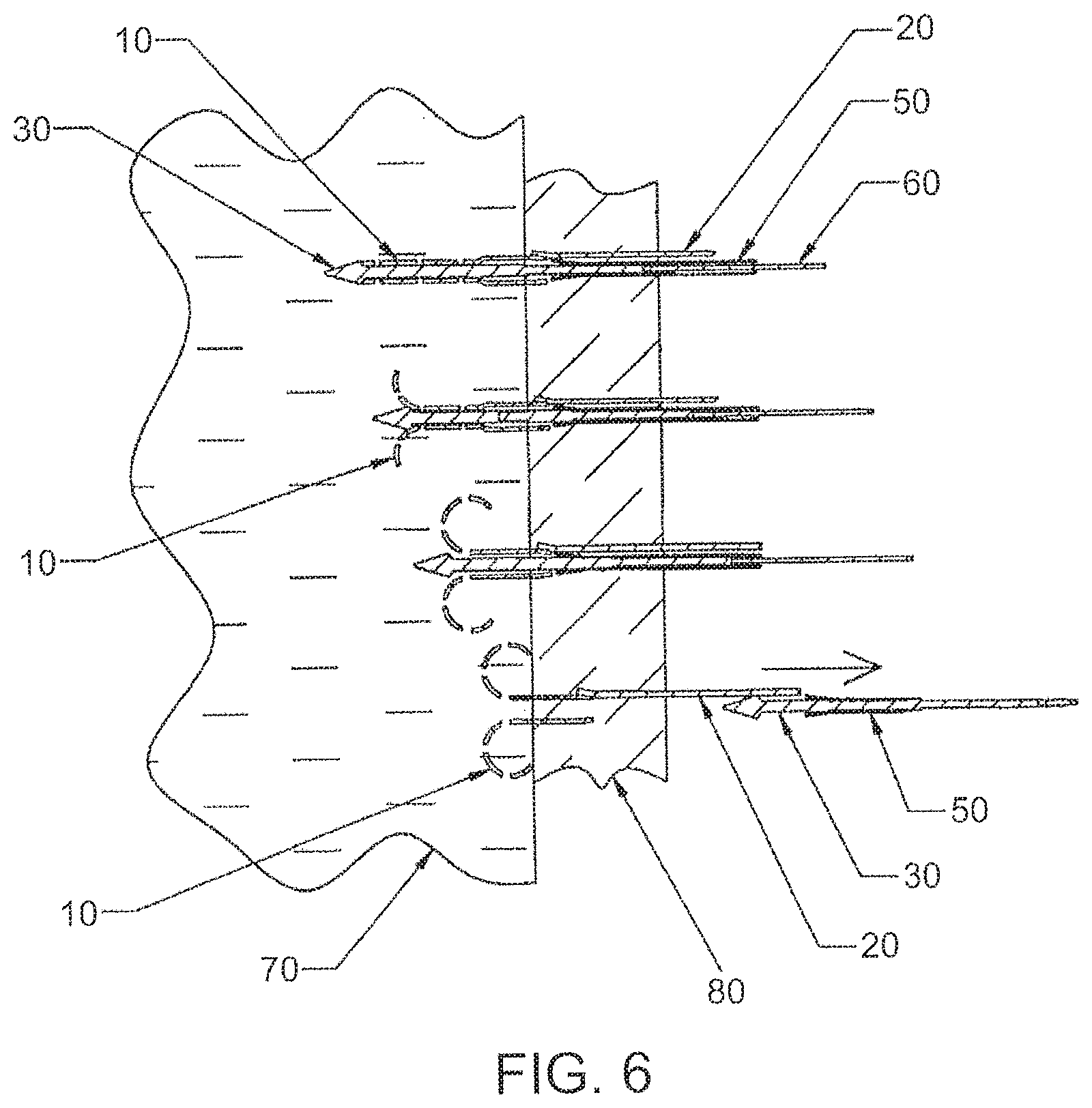 Patent US12303105 Figure 6 – Luminal structure anchoring devices and methods