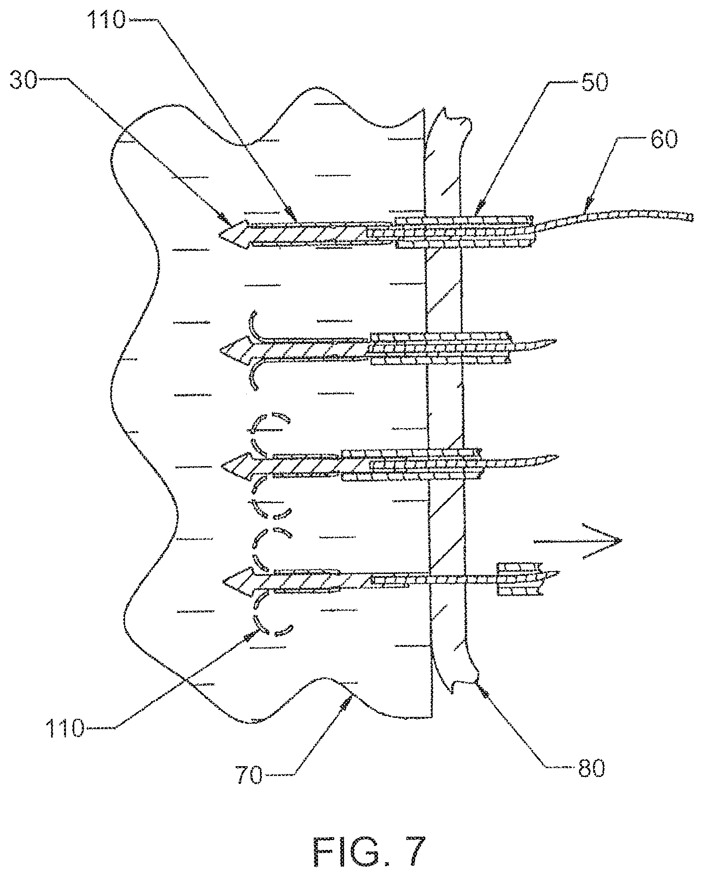 Patent US12303105 Figure 7 – Luminal structure anchoring devices and methods