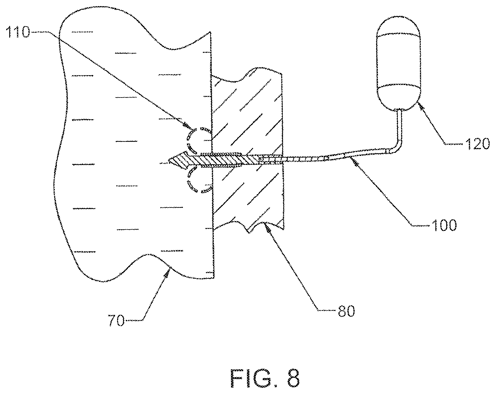 Patent US12303105 Figure 8 – Luminal structure anchoring devices and methods