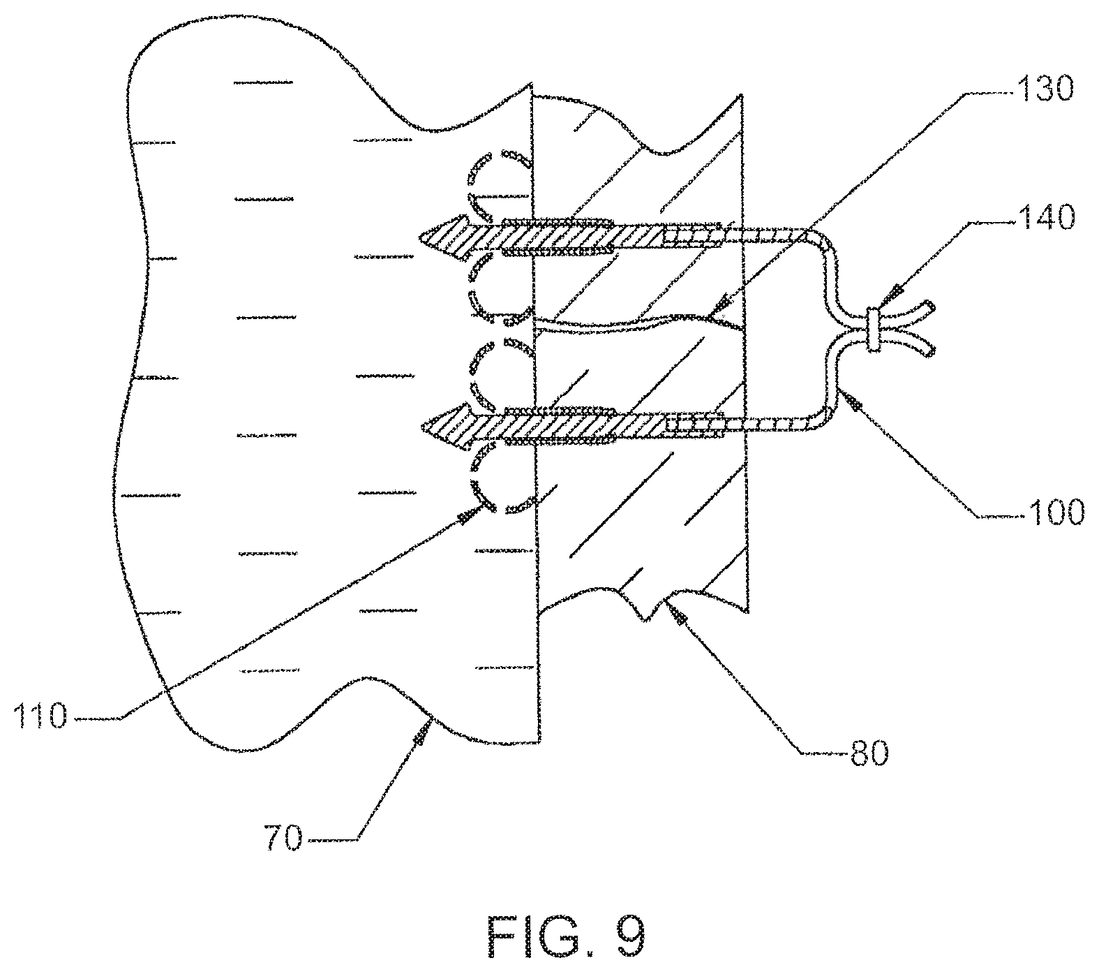 Patent US12303105 Figure 9 – Luminal structure anchoring devices and methods