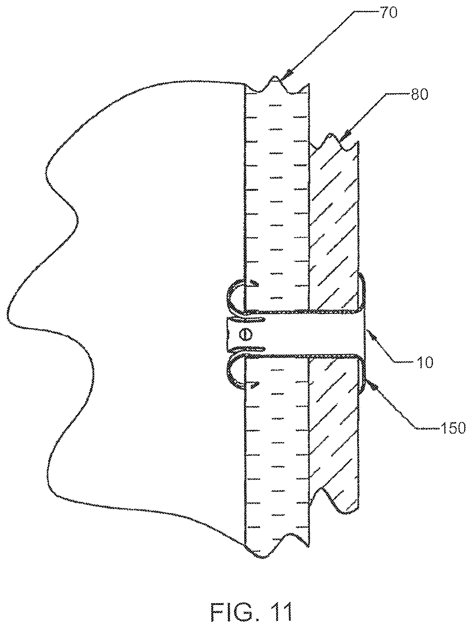 Patent US12303105 Figure 11 – Luminal structure anchoring devices and methods