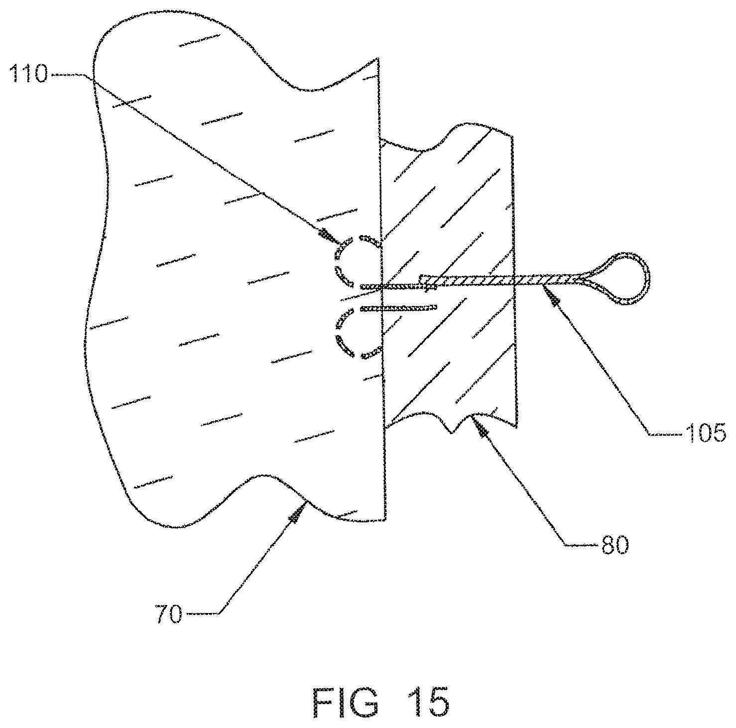 Patent US12303105 Figure 15 – Luminal structure anchoring devices and methods