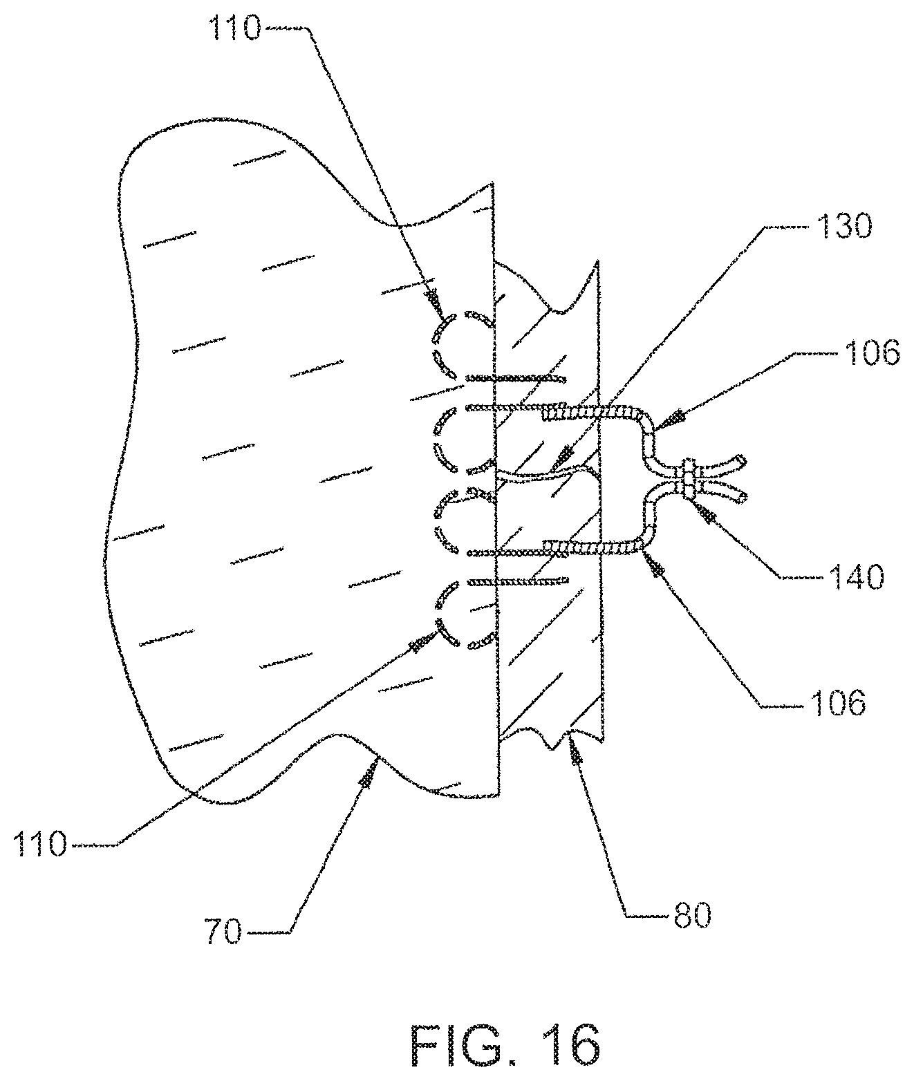 Patent US12303105 Figure 16 – Luminal structure anchoring devices and methods