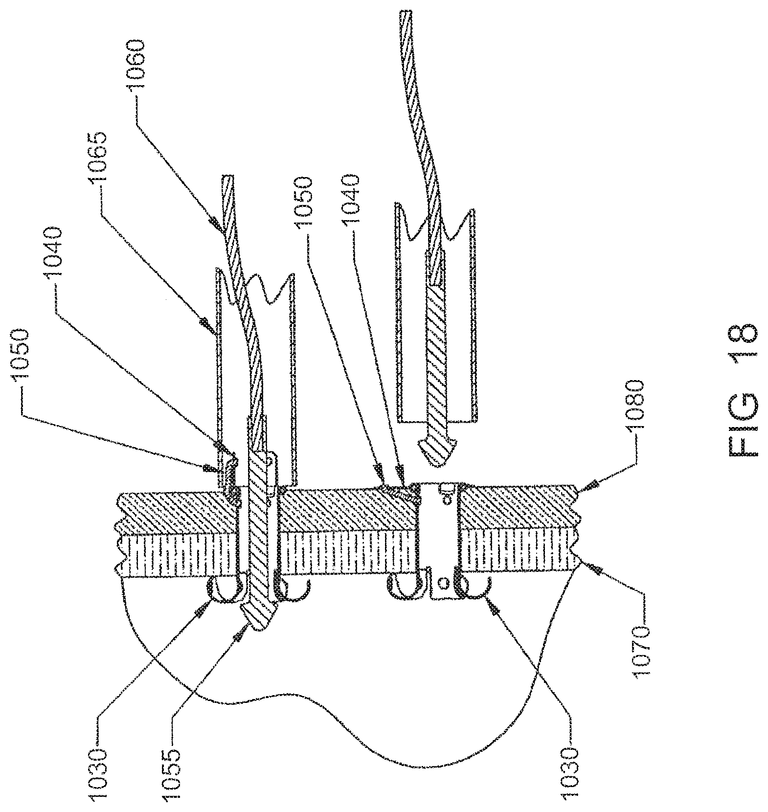 Patent US12303105 Figure 18 – Luminal structure anchoring devices and methods