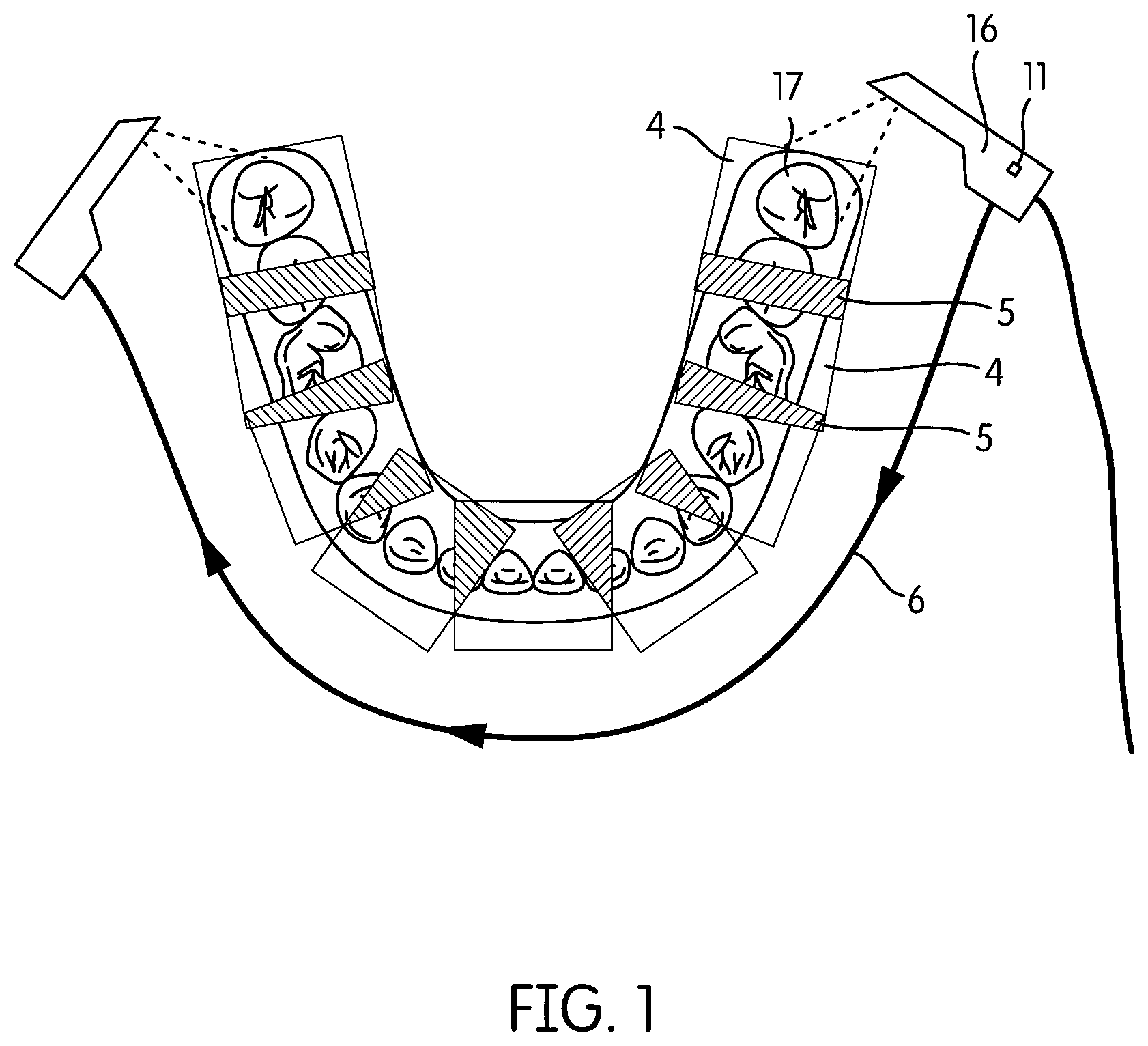 Patent US12303110 Figure 1 – Method and system for guiding an intra-oral scan
