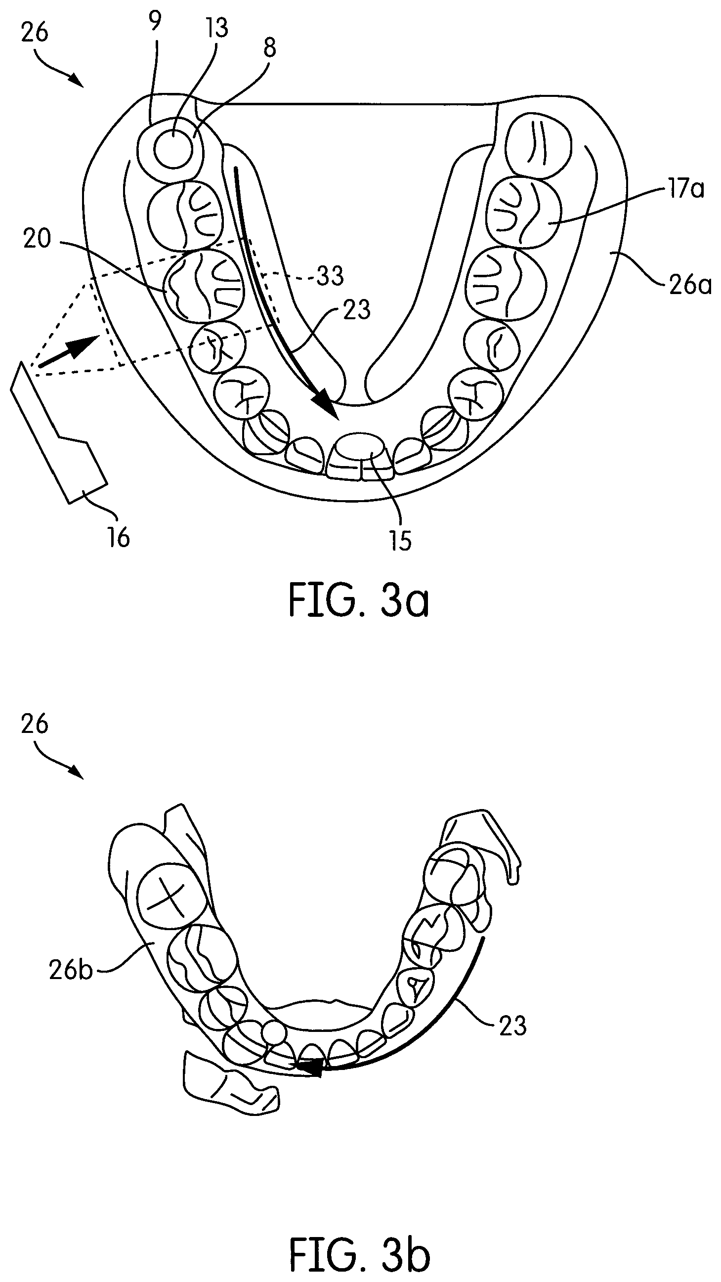 Patent US12303110 Figure 3 – Method and system for guiding an intra-oral scan