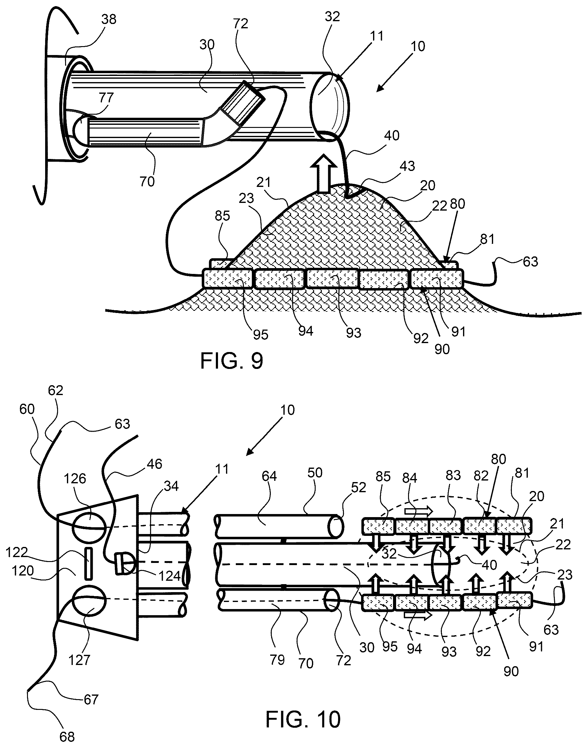Patent US12303115 Figure 5 – Endoscopic tissue inversion and resection system and method of resecting tissue
