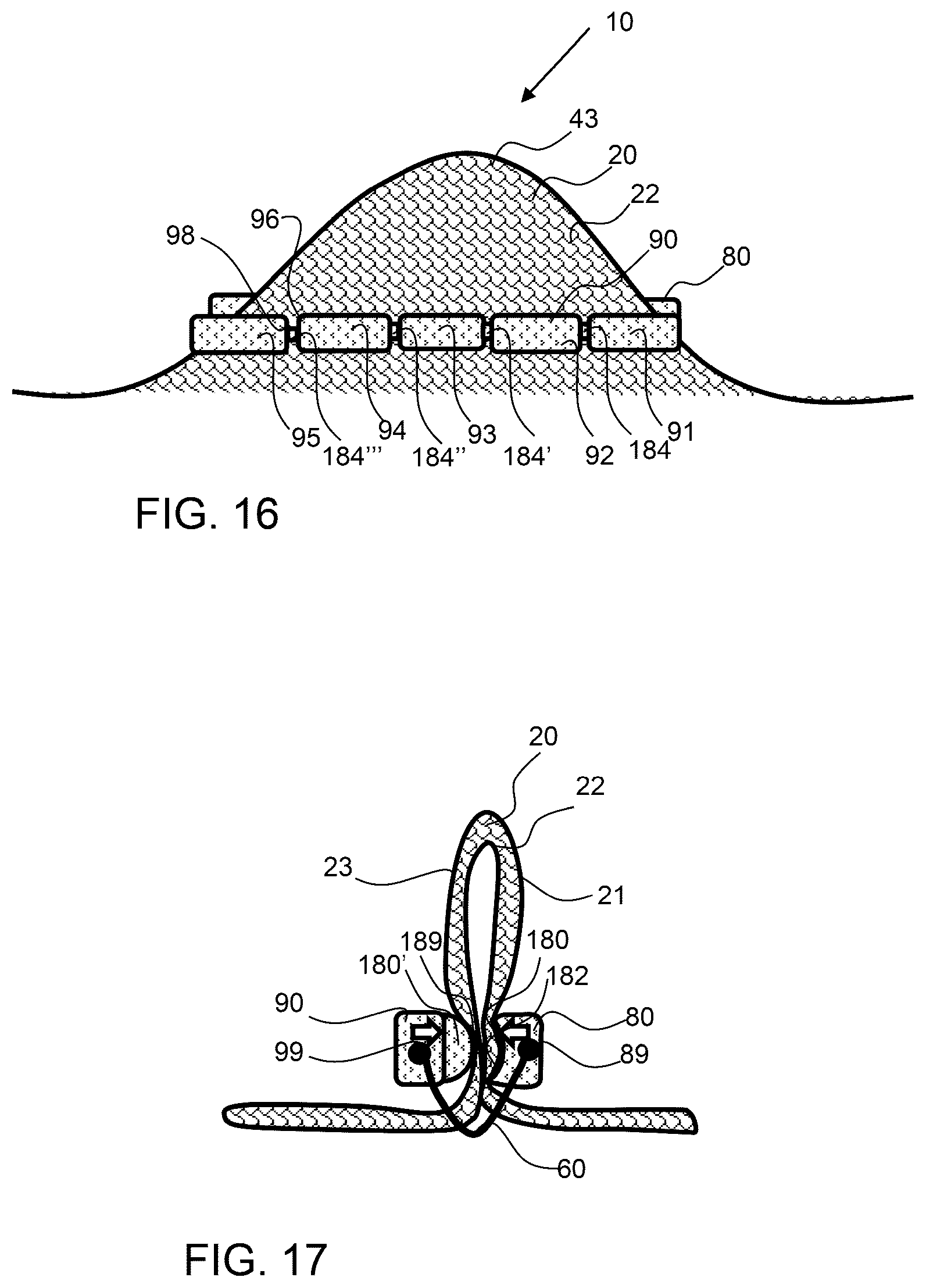 Patent US12303115 Figure 7 – Endoscopic tissue inversion and resection system and method of resecting tissue