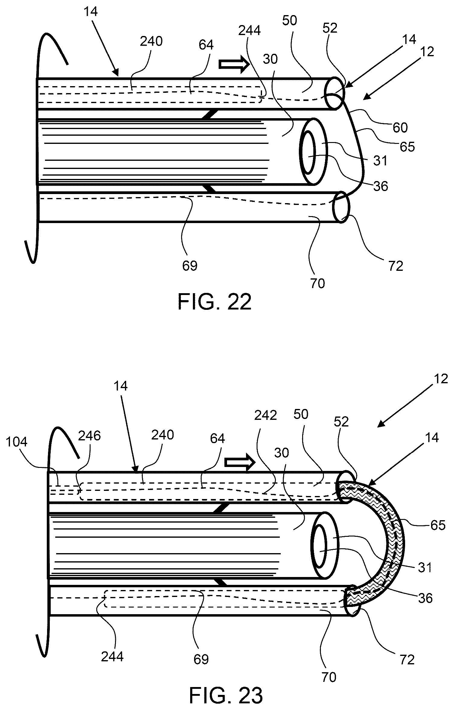 Patent US12303115 Figure 10 – Endoscopic tissue inversion and resection system and method of resecting tissue