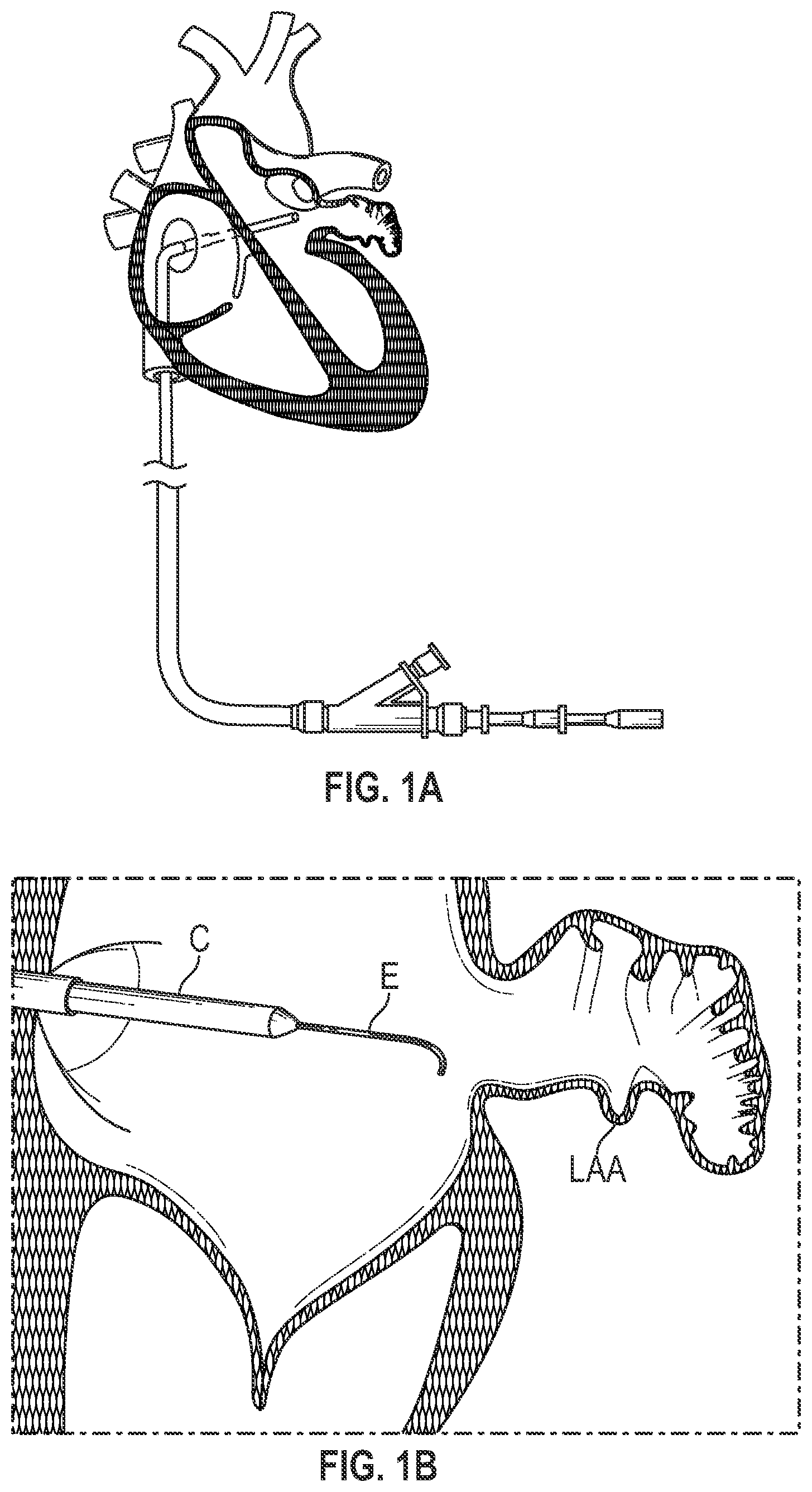 Patent US12303116 Figure 1 – Devices, systems, and methods for occluding cavities within the body