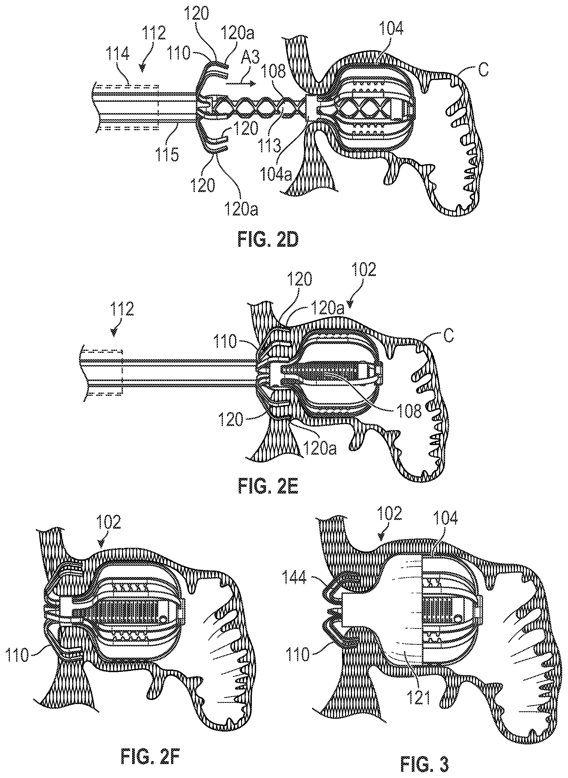 Patent US12303116 Figure 3 – Devices, systems, and methods for occluding cavities within the body
