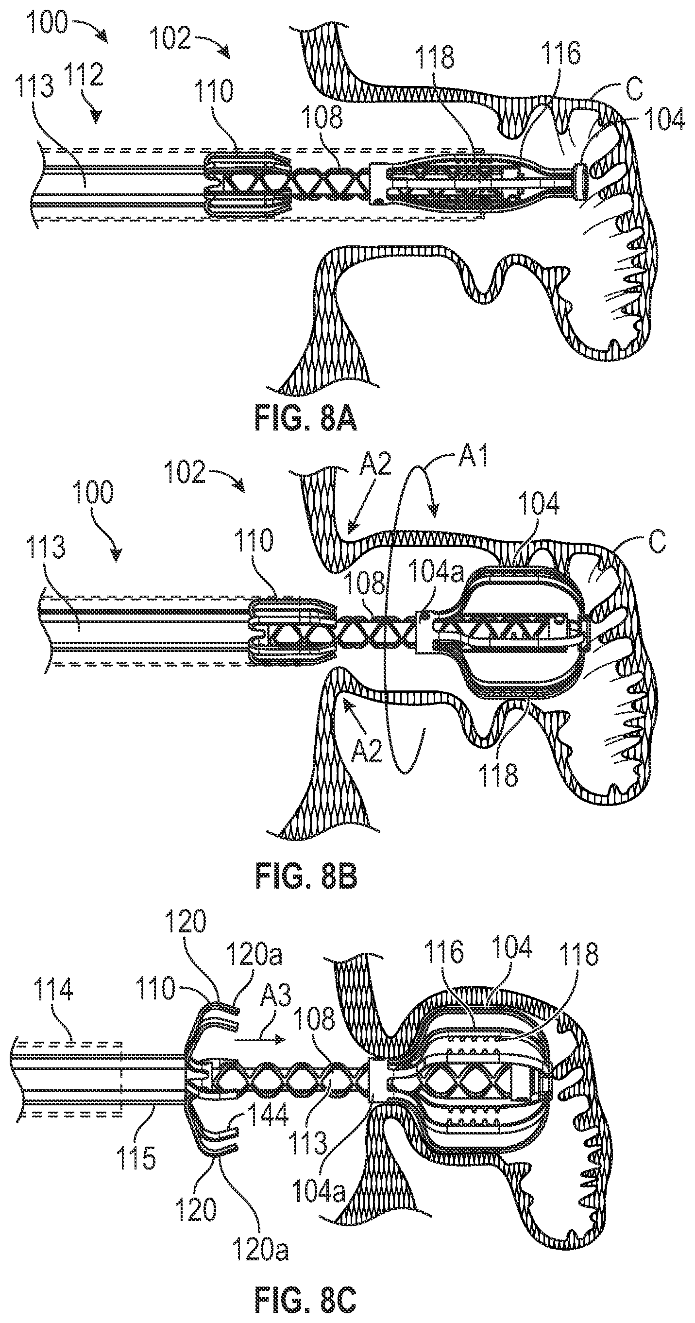 Patent US12303116 Figure 6 – Devices, systems, and methods for occluding cavities within the body