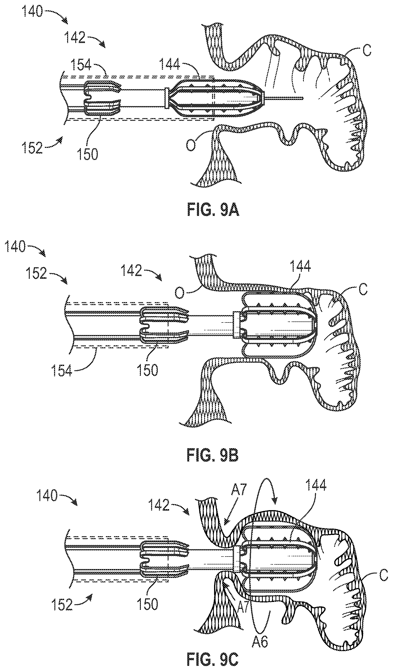 Patent US12303116 Figure 7 – Devices, systems, and methods for occluding cavities within the body