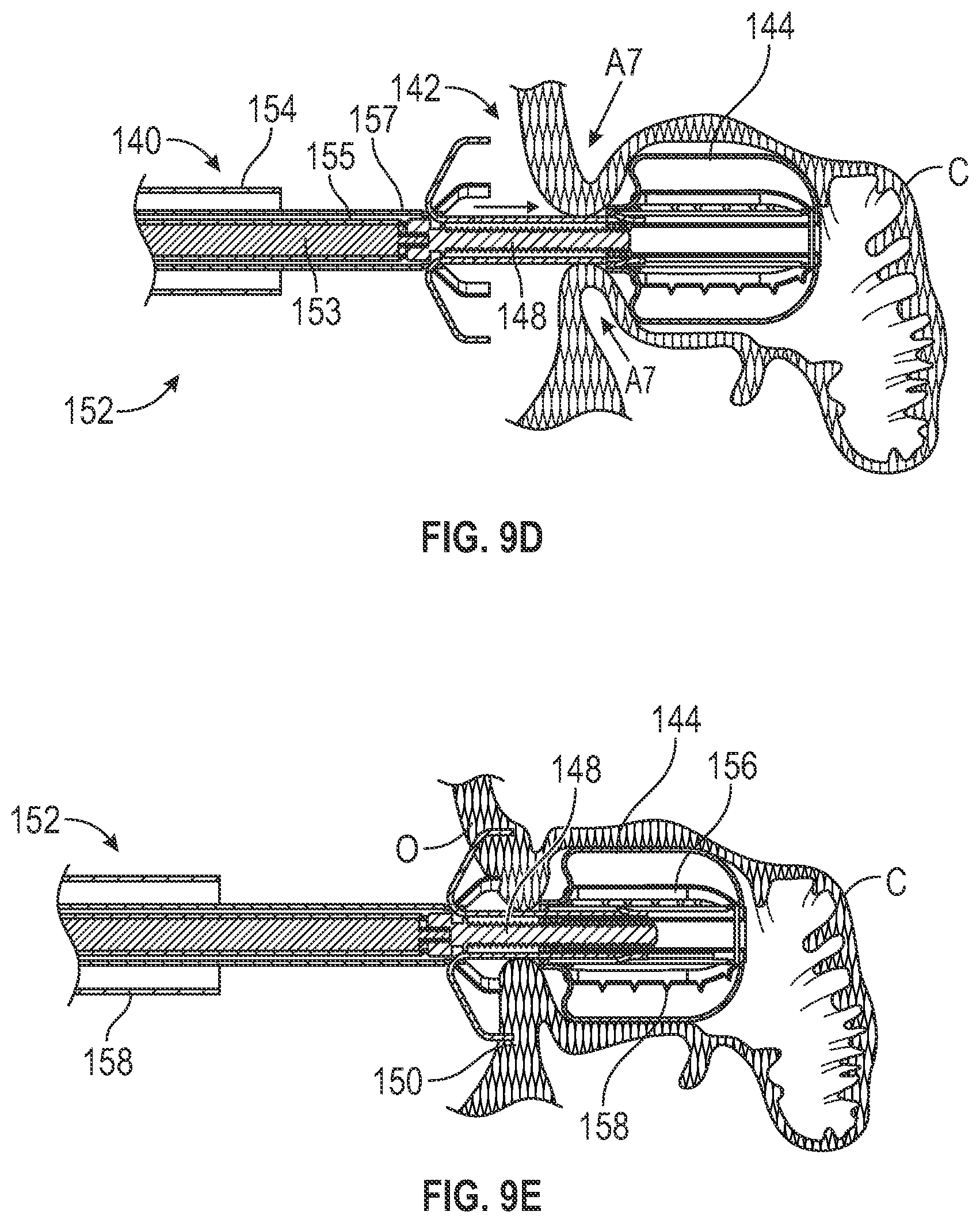 Patent US12303116 Figure 8 – Devices, systems, and methods for occluding cavities within the body