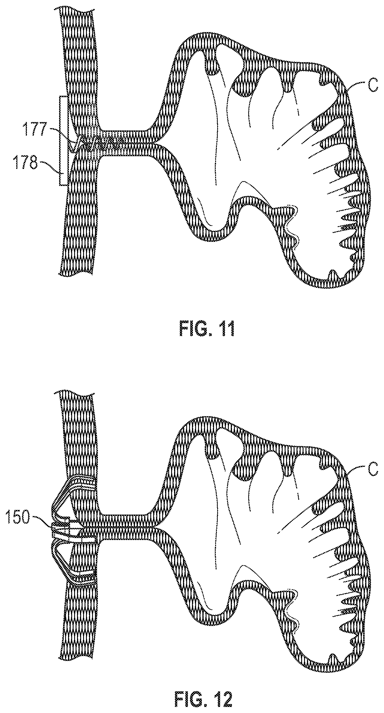 Patent US12303116 Figure 12 – Devices, systems, and methods for occluding cavities within the body
