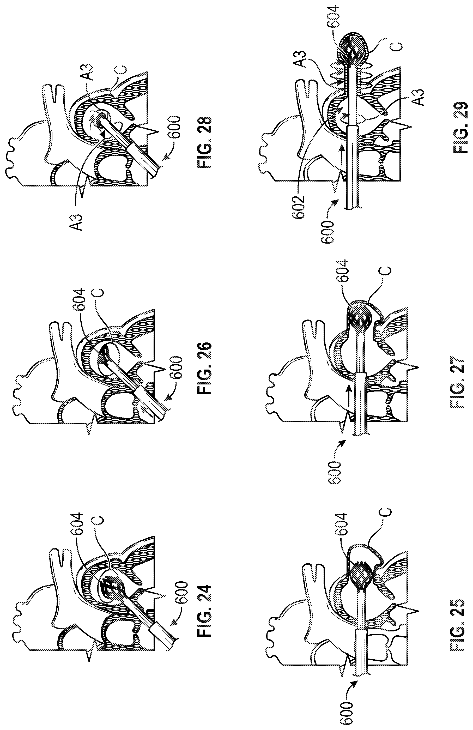 Patent US12303116 Figure 19 – Devices, systems, and methods for occluding cavities within the body