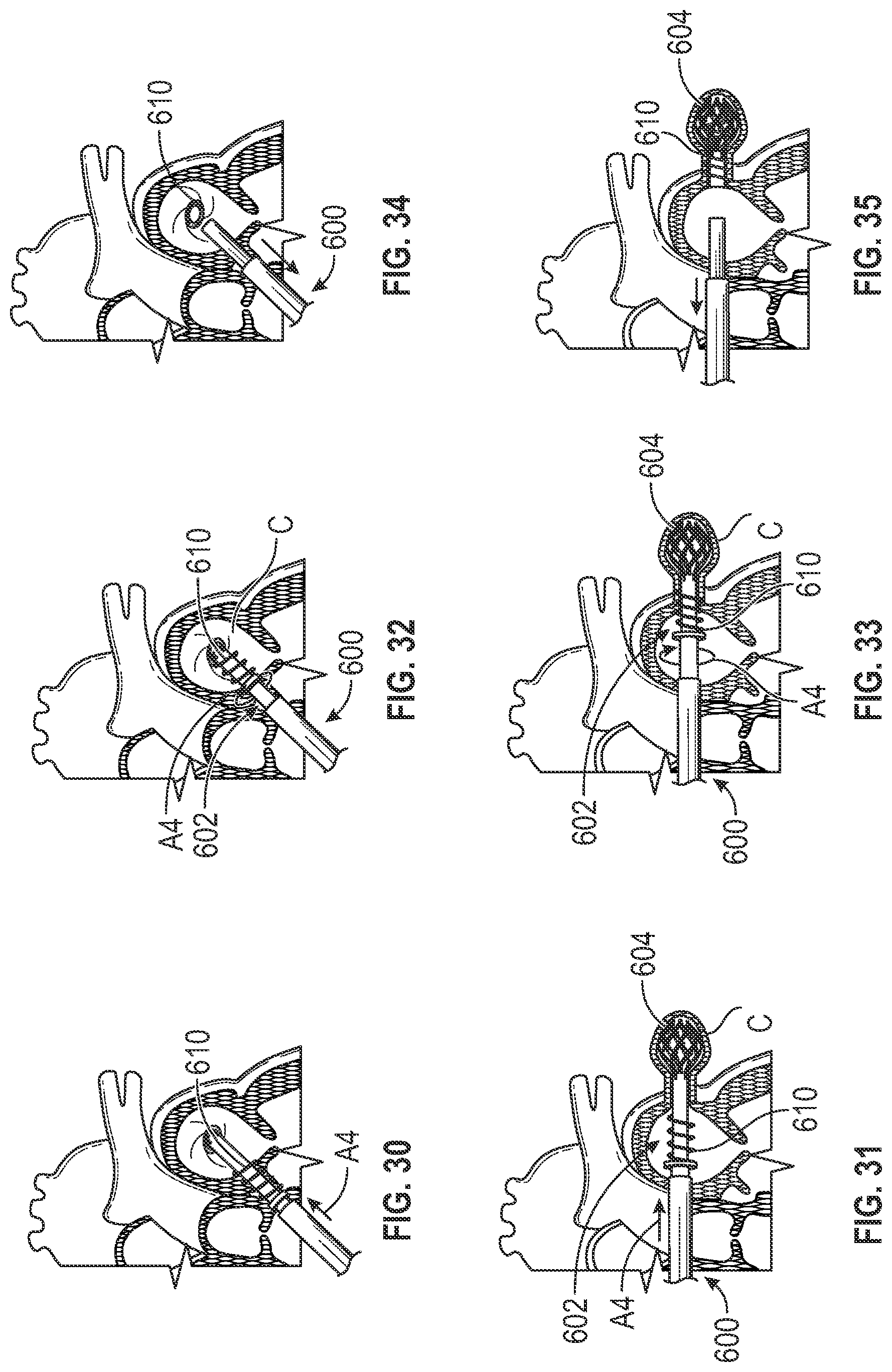 Patent US12303116 Figure 20 – Devices, systems, and methods for occluding cavities within the body