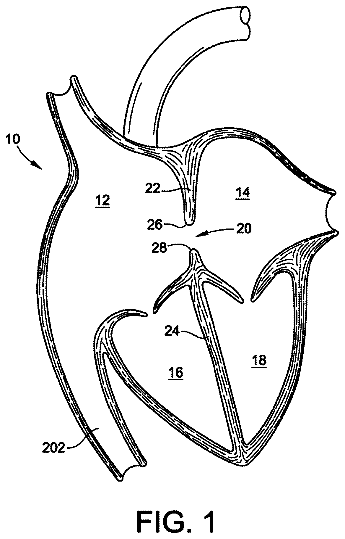 Patent US12303117 Figure 1 – Asymmetric occluder device