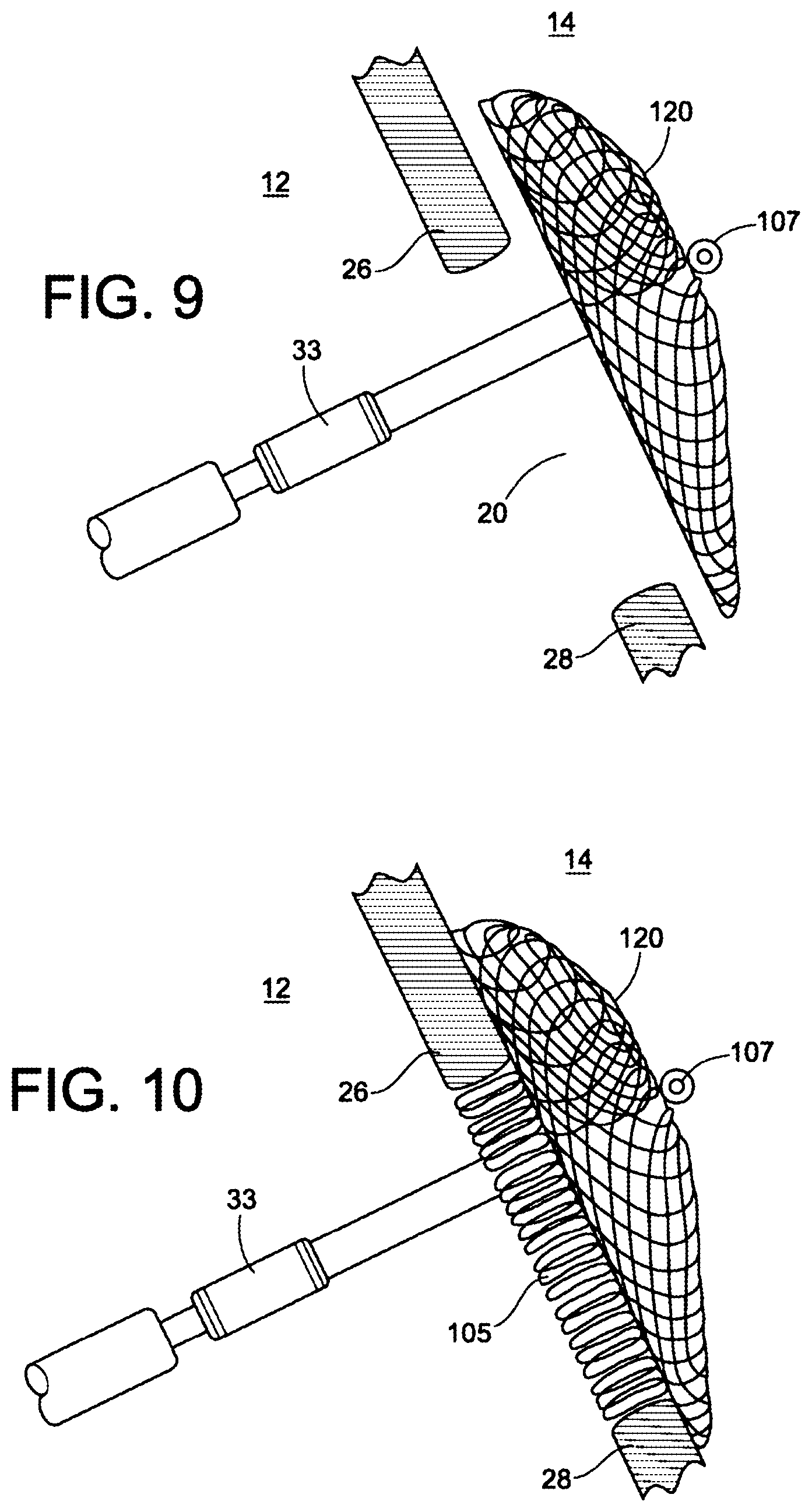 Patent US12303117 Figure 6 – Asymmetric occluder device