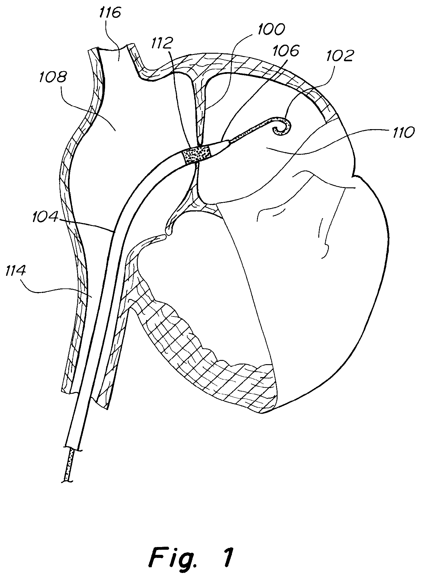 Patent US12303119 Figure 1 – Apparatus and methods to create and maintain an intra-atrial pressure relief opening