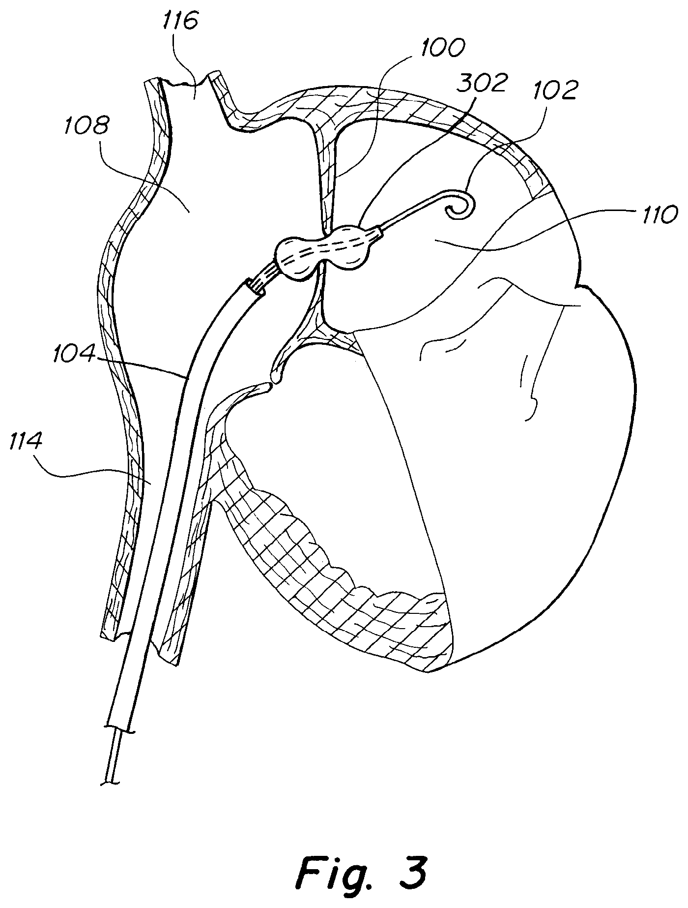 Patent US12303119 Figure 4 – Apparatus and methods to create and maintain an intra-atrial pressure relief opening