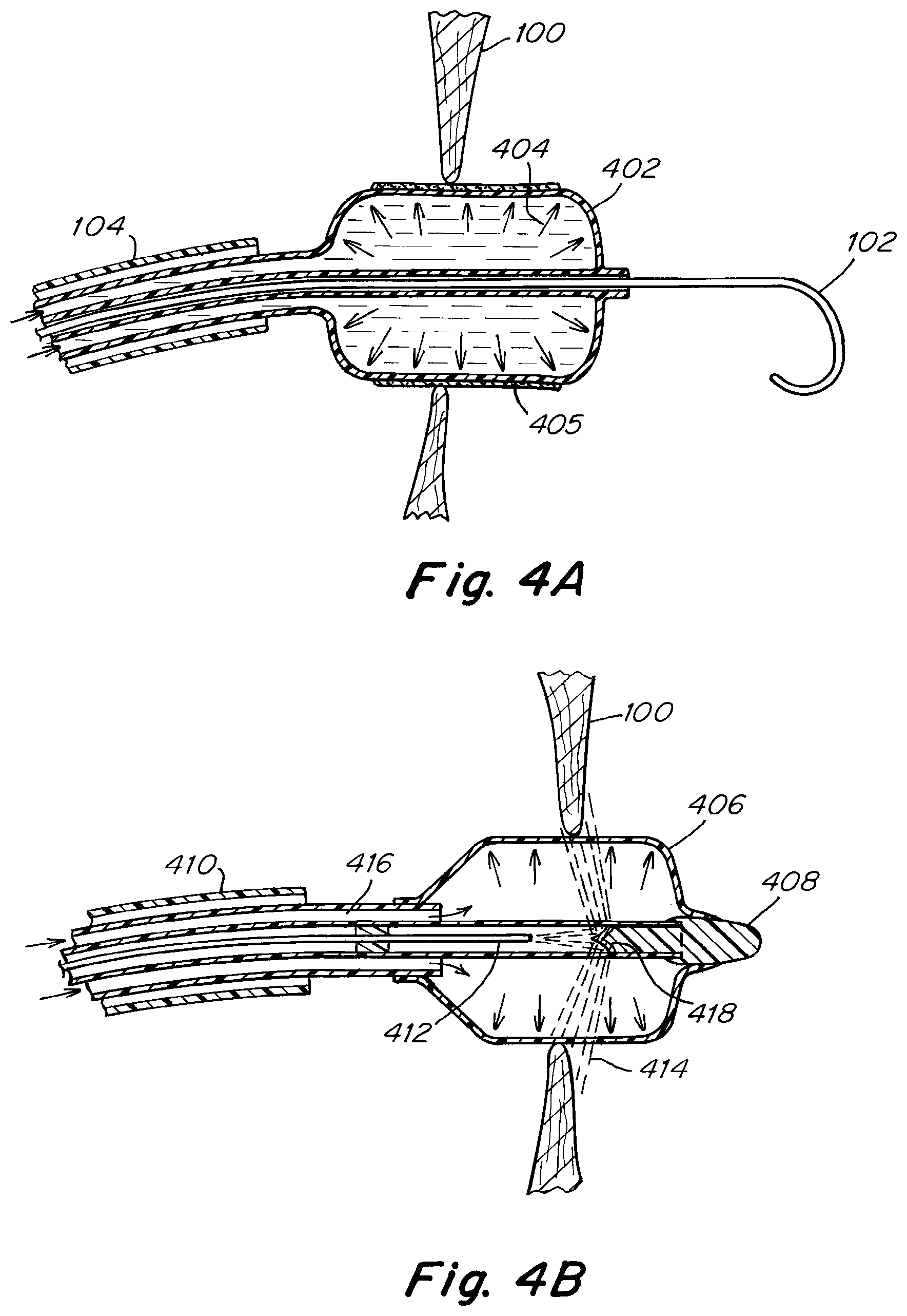 Patent US12303119 Figure 5 – Apparatus and methods to create and maintain an intra-atrial pressure relief opening
