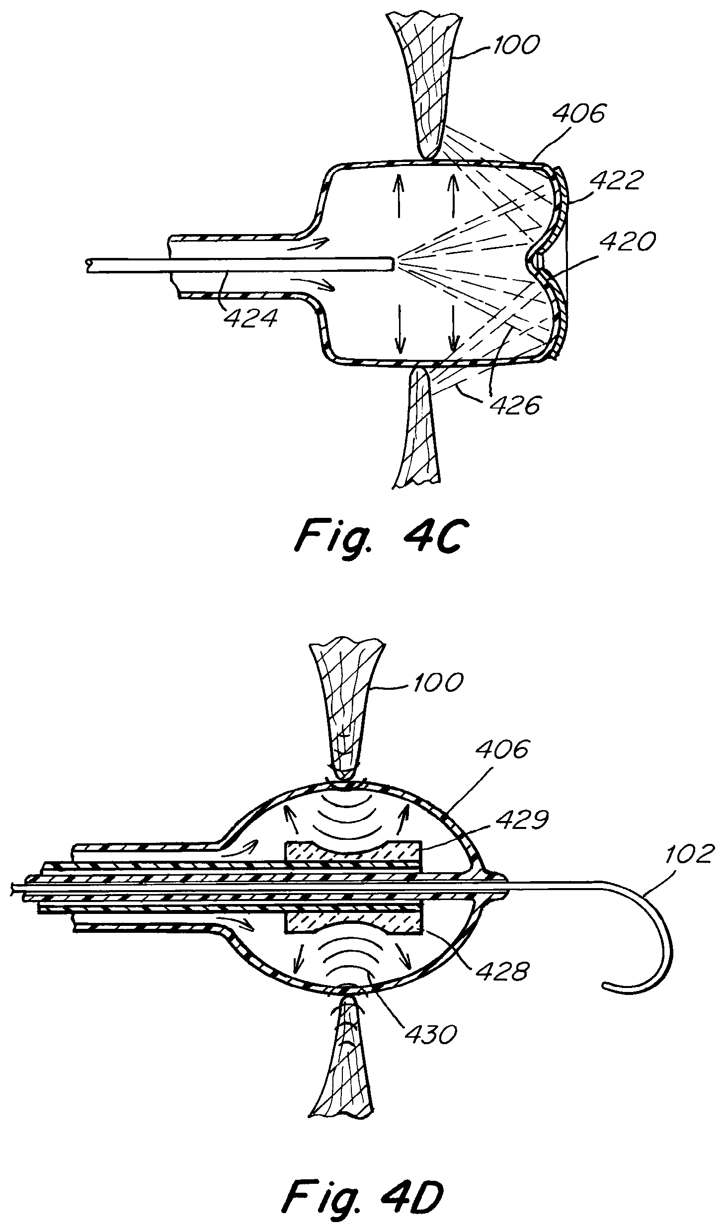 Patent US12303119 Figure 6 – Apparatus and methods to create and maintain an intra-atrial pressure relief opening