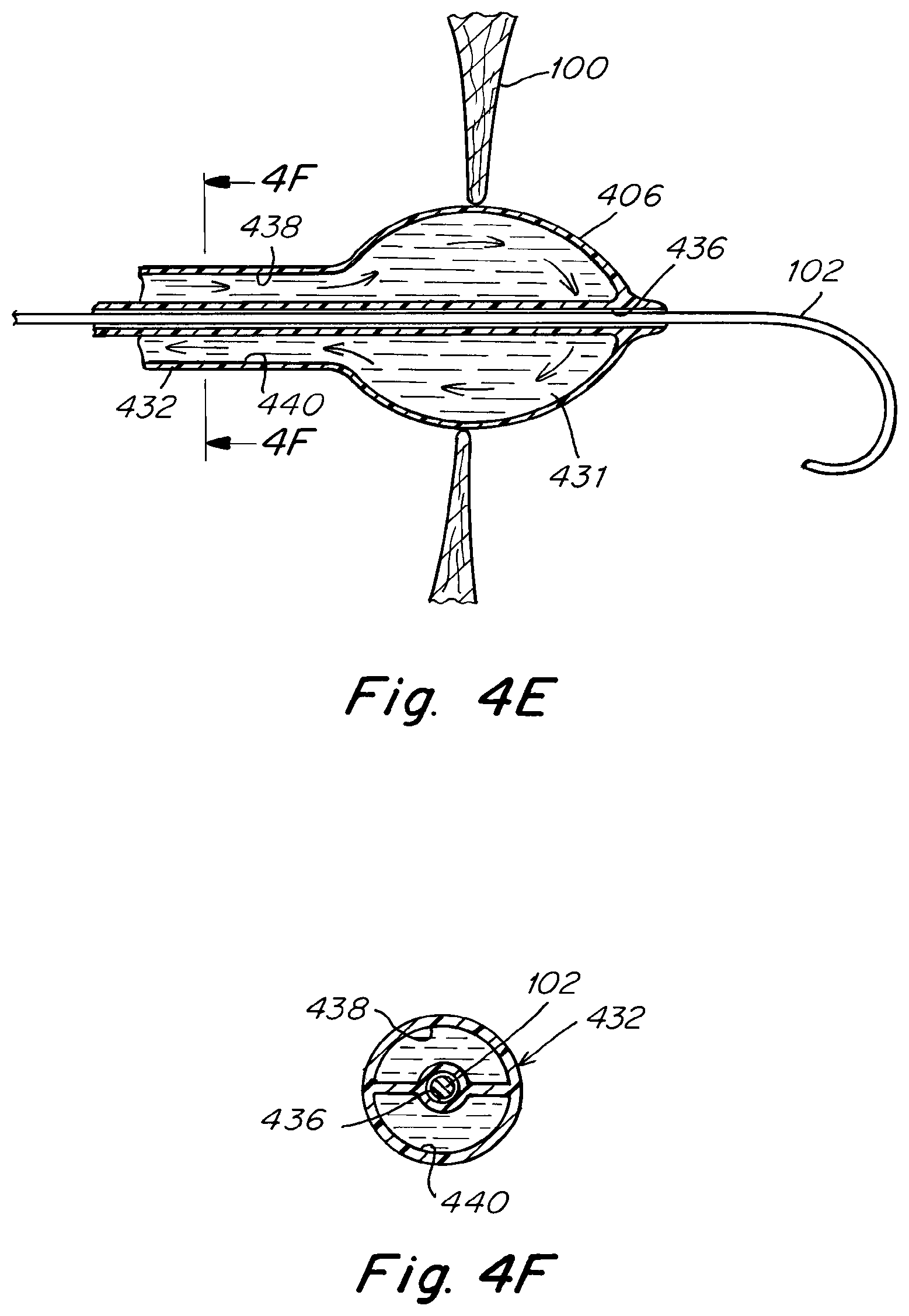 Patent US12303119 Figure 7 – Apparatus and methods to create and maintain an intra-atrial pressure relief opening