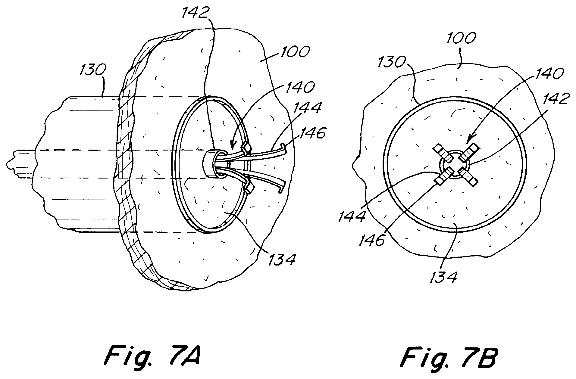 Patent US12303119 Figure 11 – Apparatus and methods to create and maintain an intra-atrial pressure relief opening