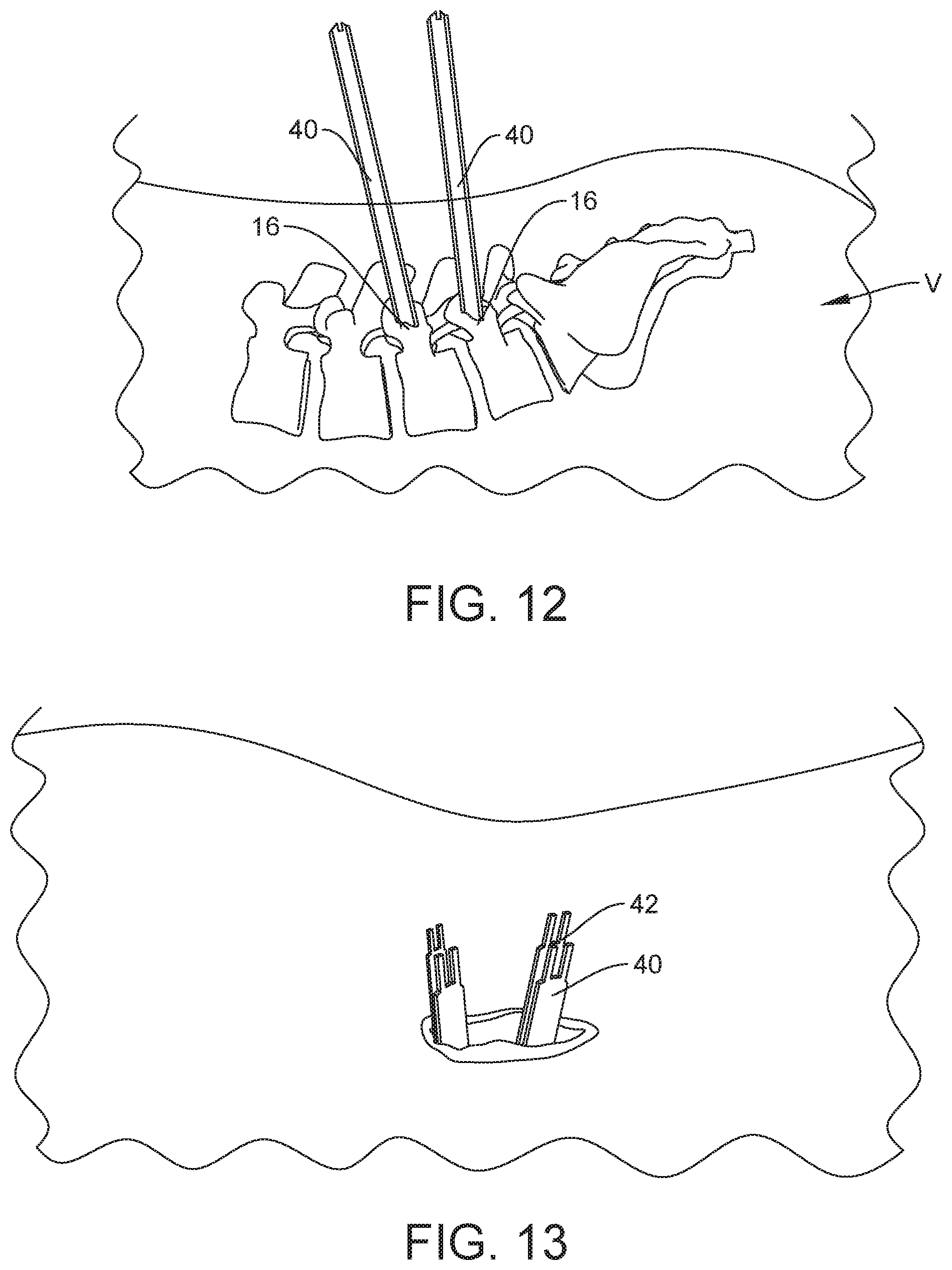 Patent US12303121 Figure 9 – Surgical system and method