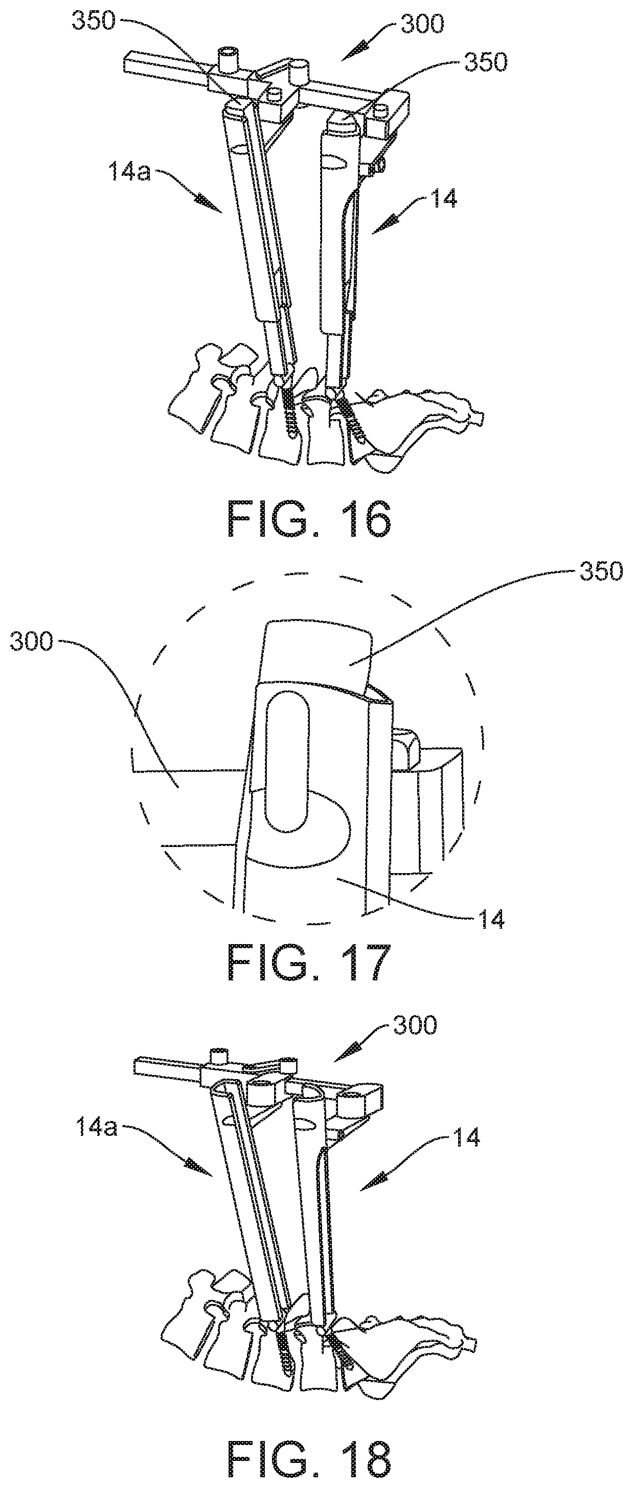 Patent US12303121 Figure 11 – Surgical system and method
