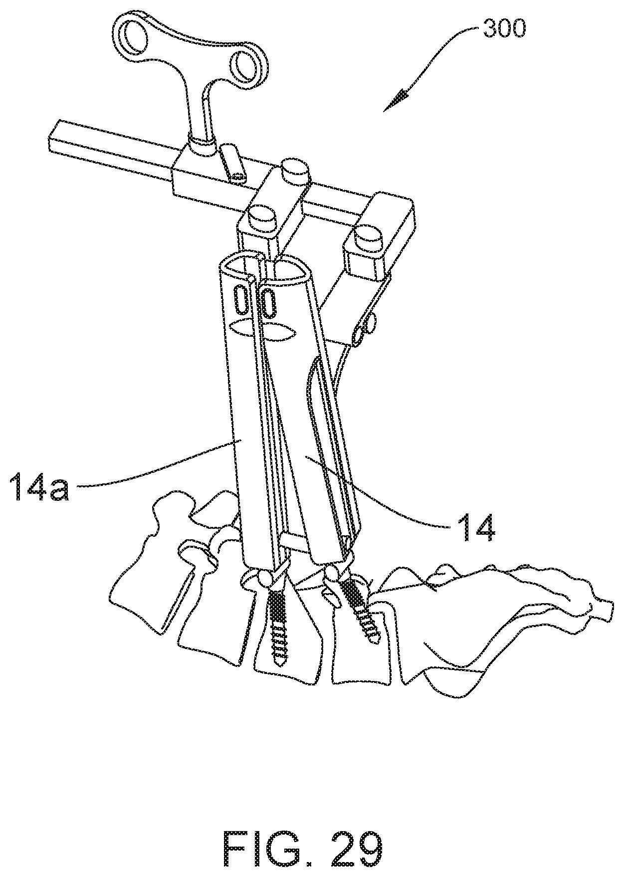 Patent US12303121 Figure 17 – Surgical system and method